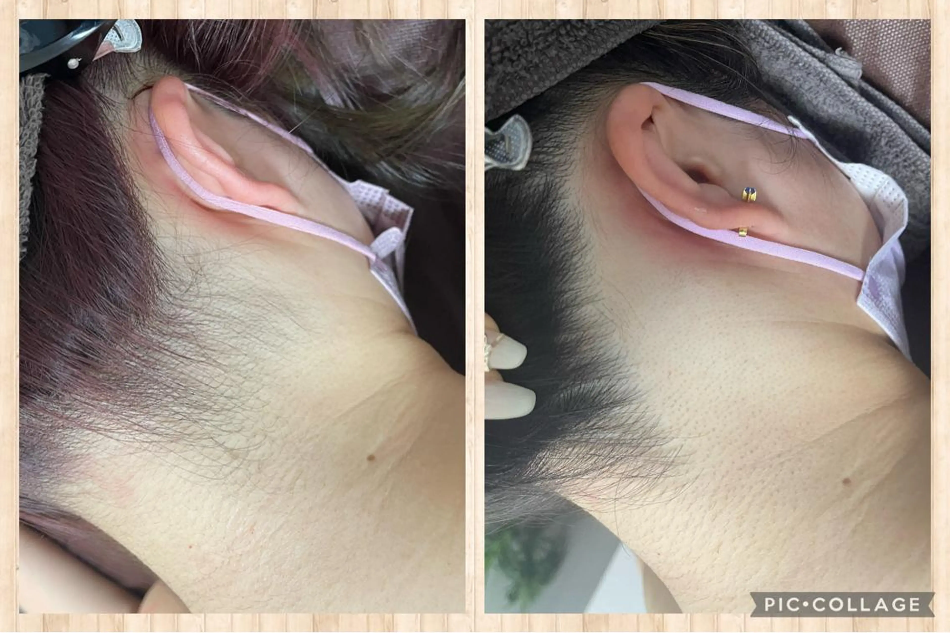 襟足/首前/腰 1部位の写真