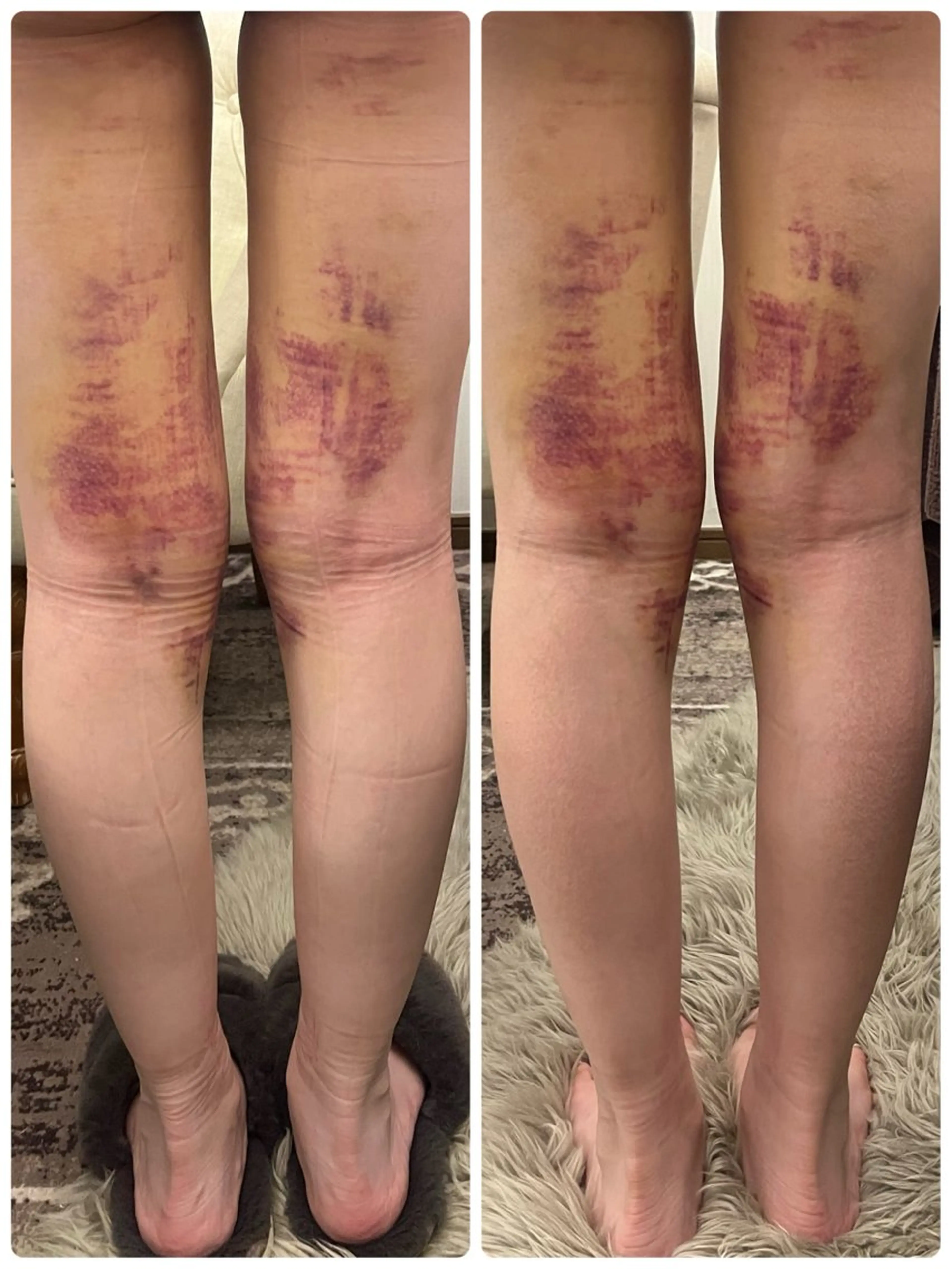 【術後専用】DTケアの痛み、浮腫みの軽減に早期改善を目指す◎お顔、二の腕、お腹のお悩みに合わせて選べる1部位の写真