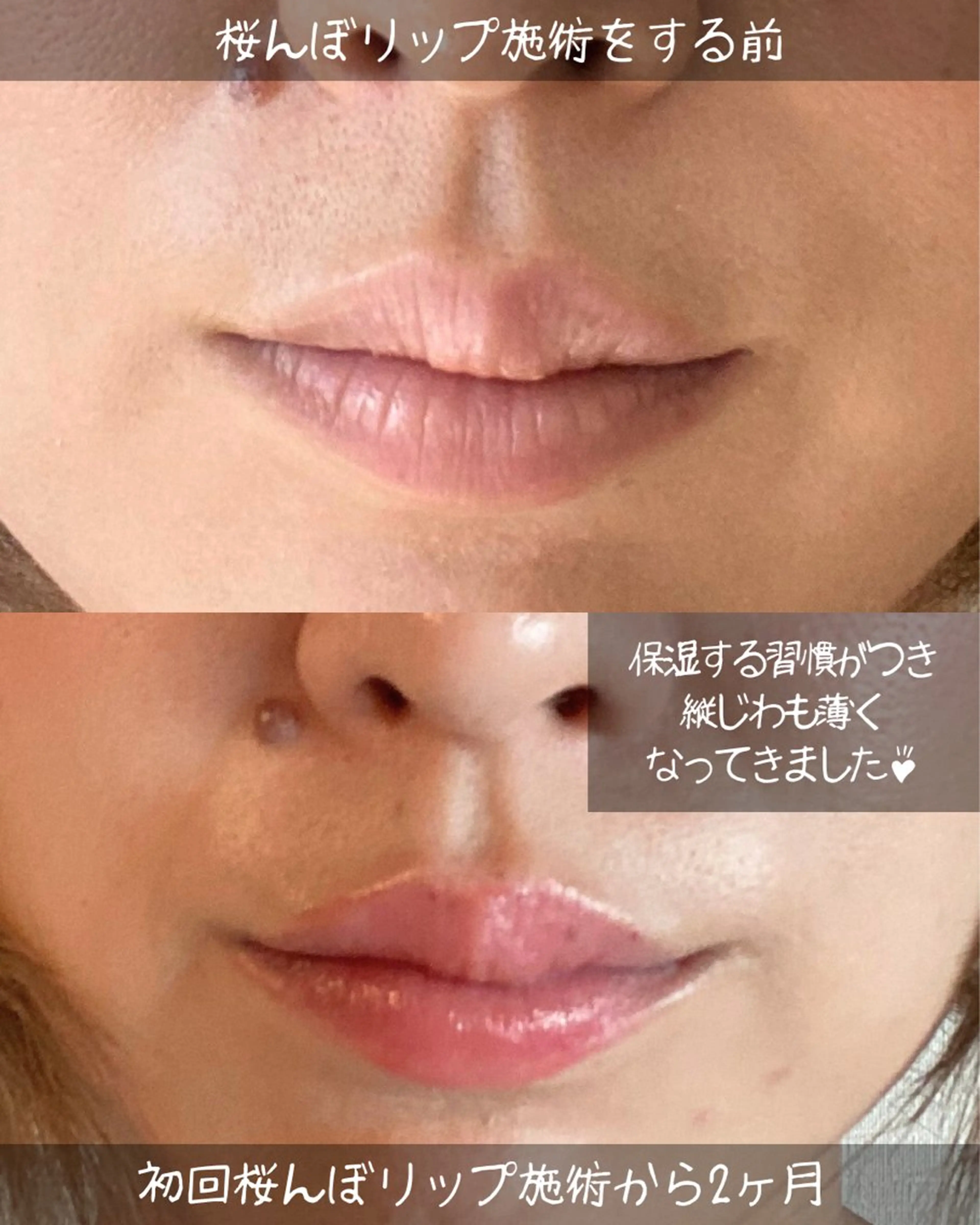 【年齢とともに色が薄くなった方】🌸桜んぼリップカウンセリング＋ドライヘッドマッサージ30分／2,000円🌸の写真