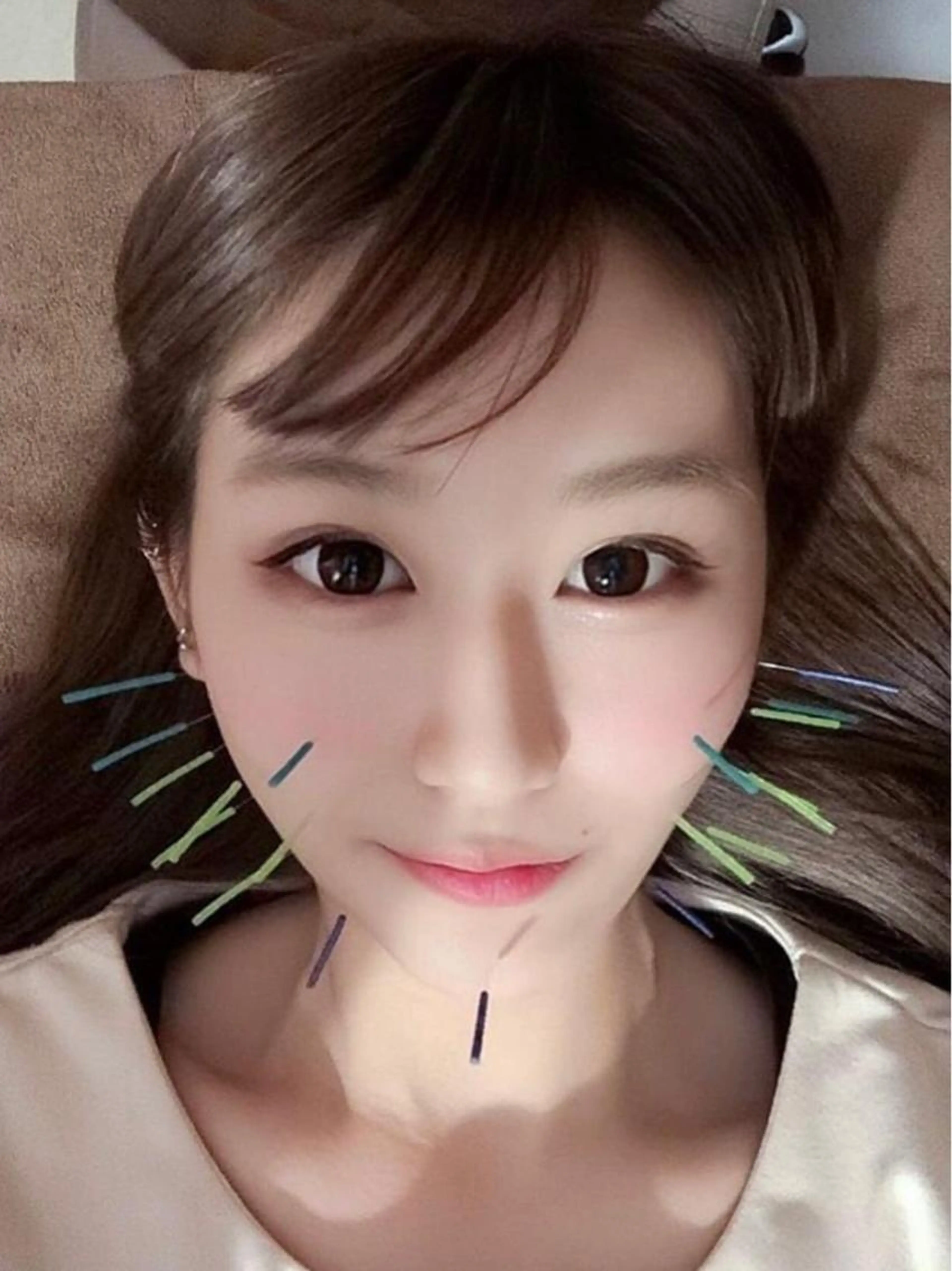 🌈期間限定メニュー🌈美容鍼(美顔針)＋ローラ鍼の写真