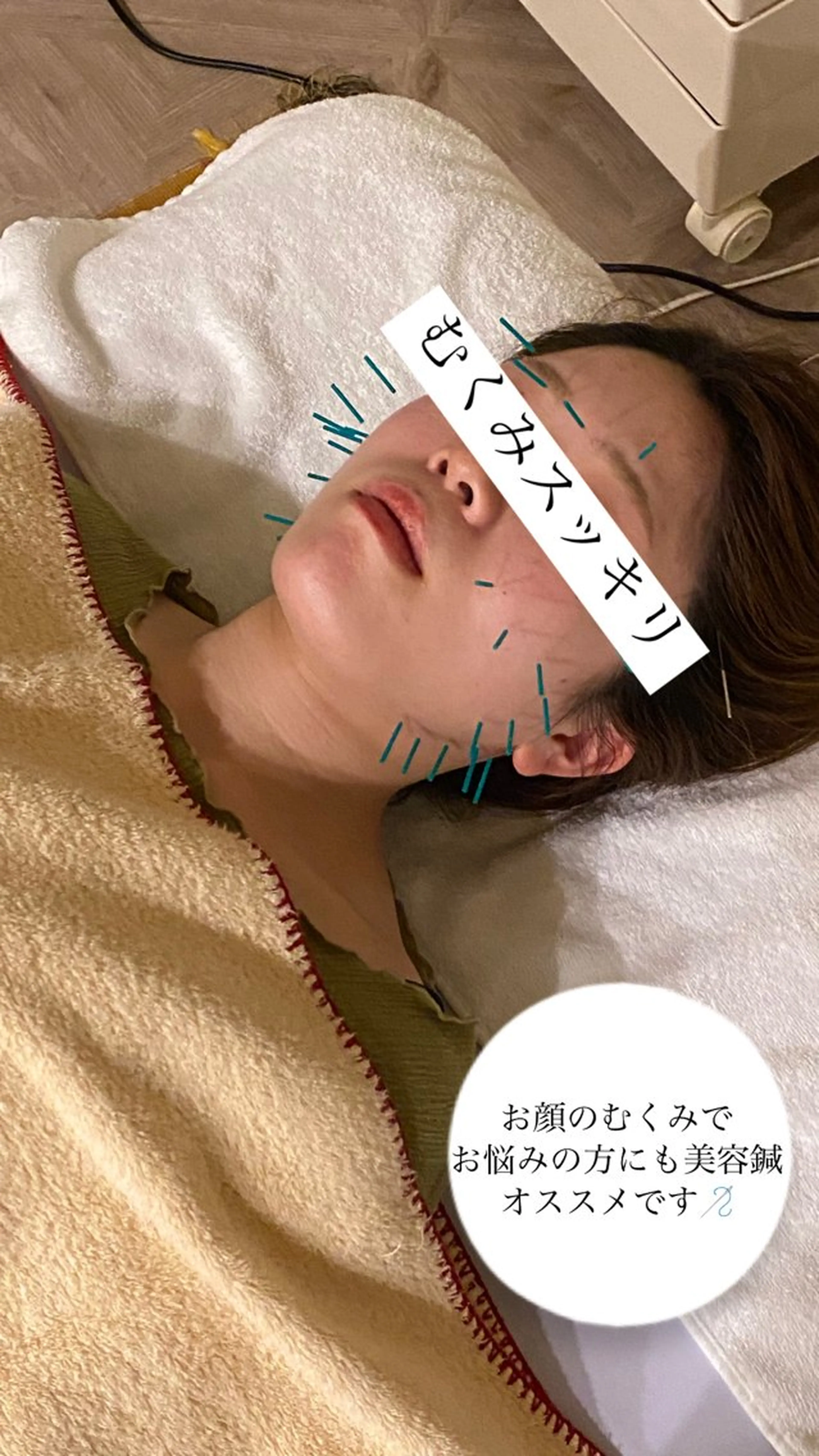 美容鍼/ヘッドスパ/ 💎さかもとのエステ・リラクイメージ