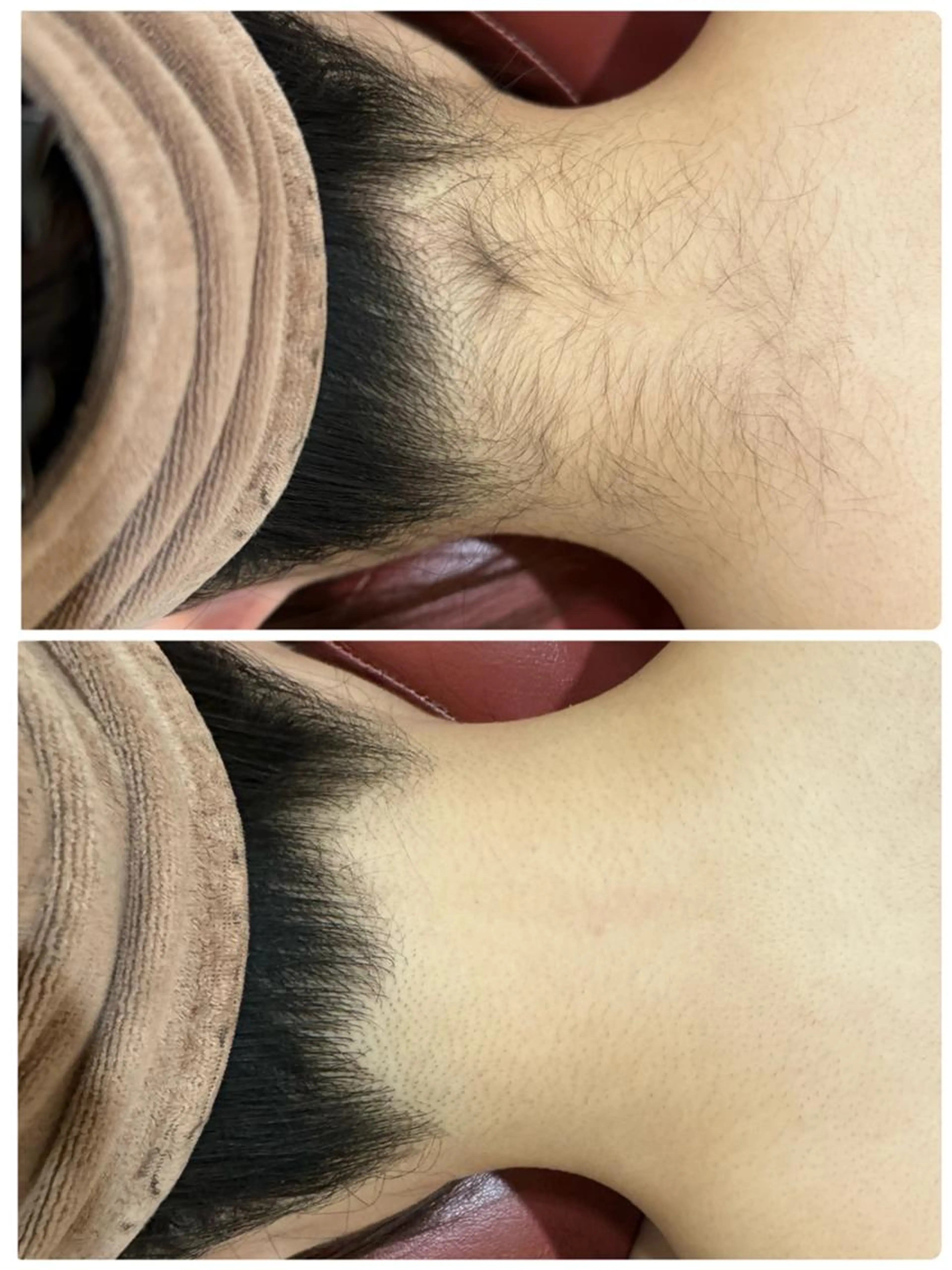 🎀美人うなじ脱毛　(シェービング付き)　1980円　えりあし美人へ✨の写真