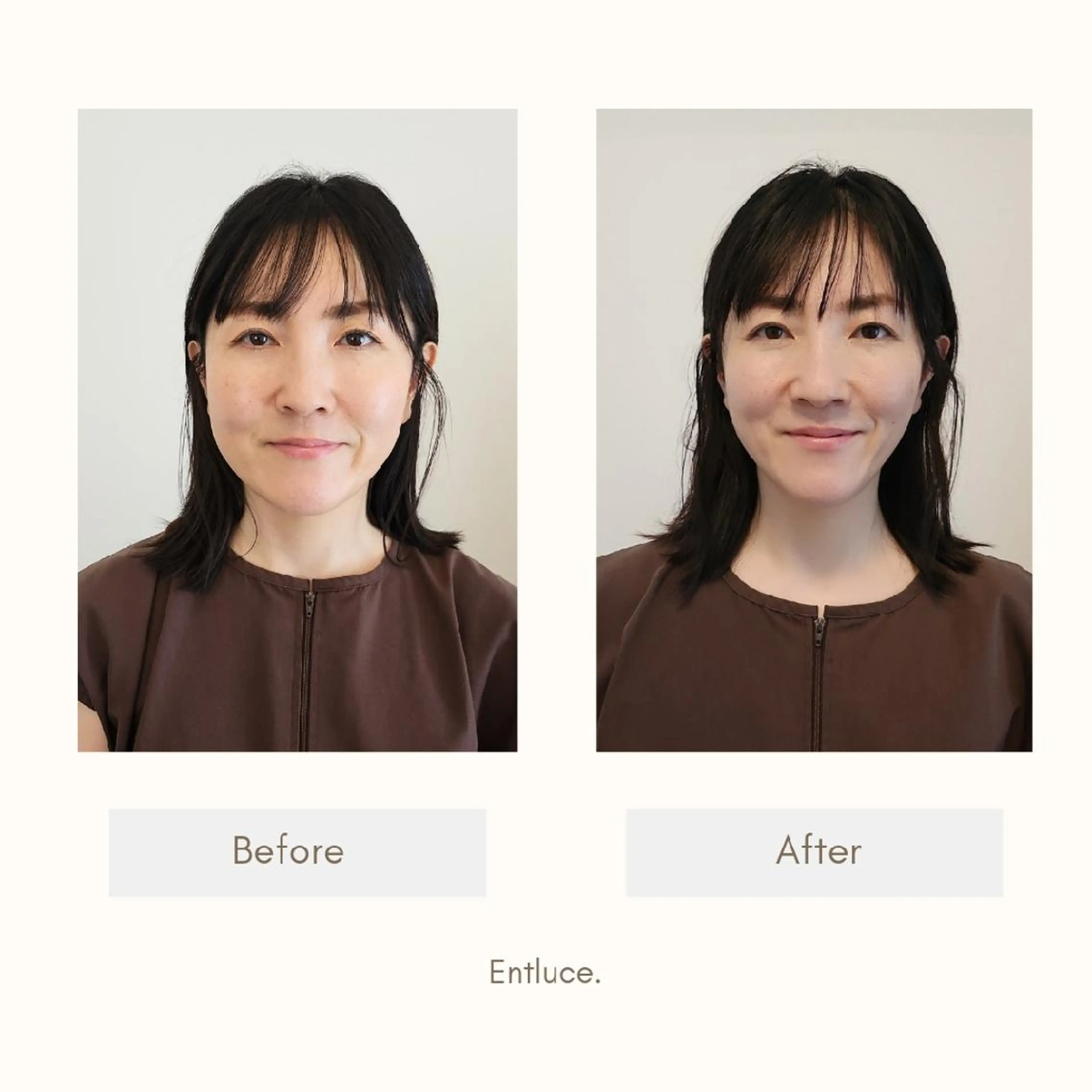 エステ リラク 即効⚡小顔美容鍼🪡 むくみたるみ脂肪解消のエステ・リラクイメージ