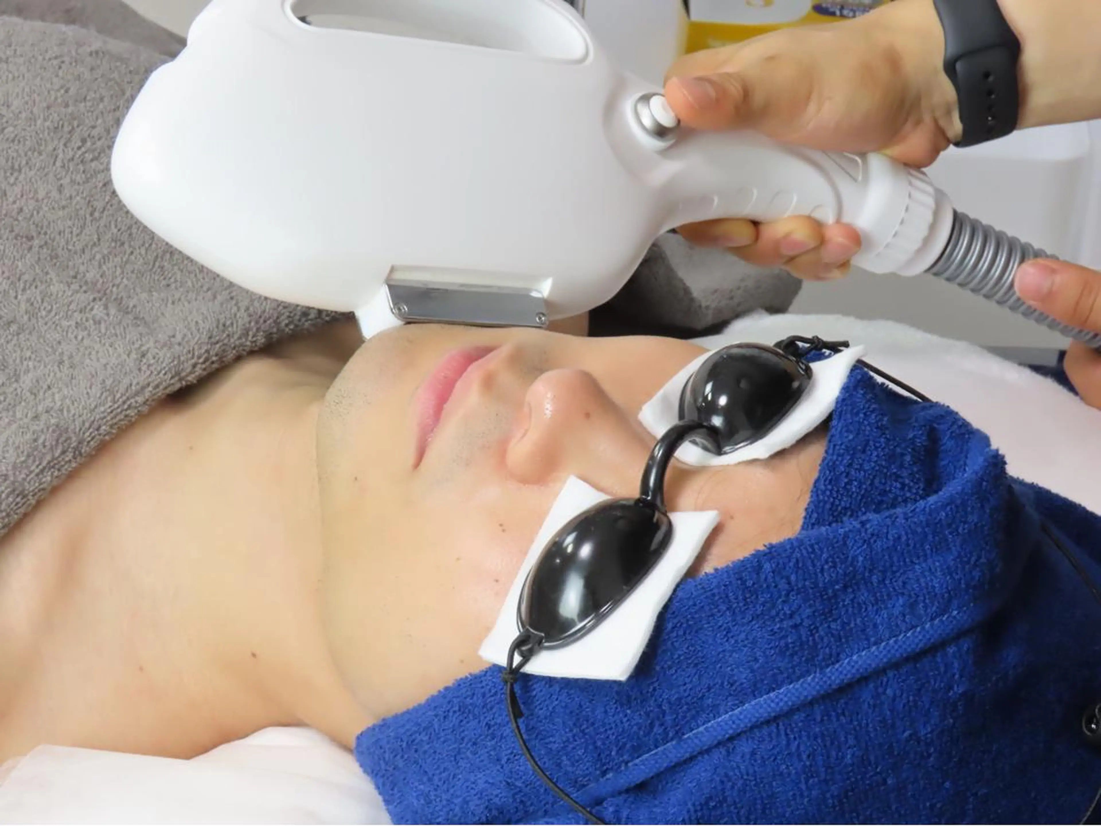 男性　全身光脱毛　(VIOまたは顔含む)回数:1回　都度払い　¥17800→¥8900の写真