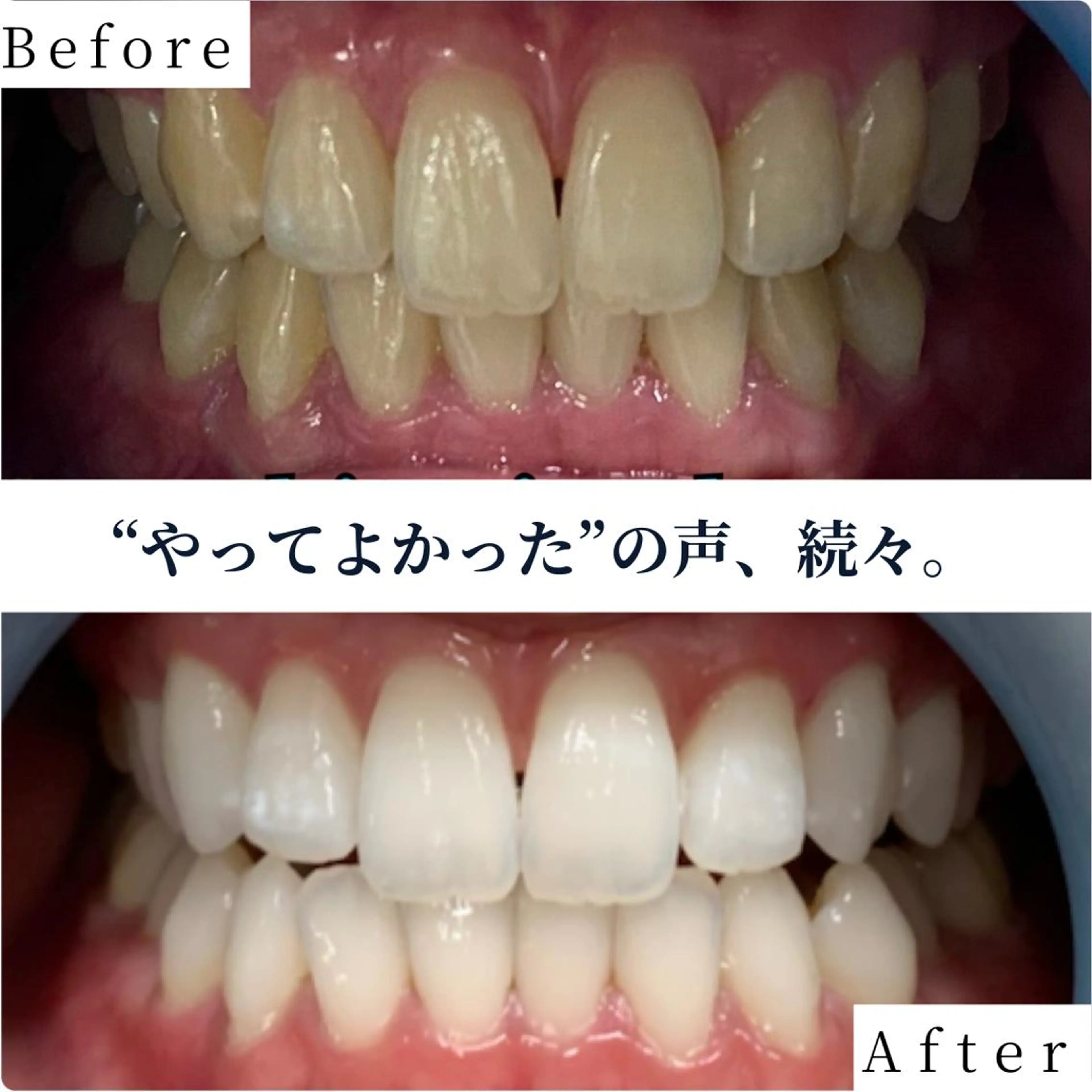 【都度払い✨】気になったその時に◎美白セルフホワイトニング 40分照射 ¥6980の写真