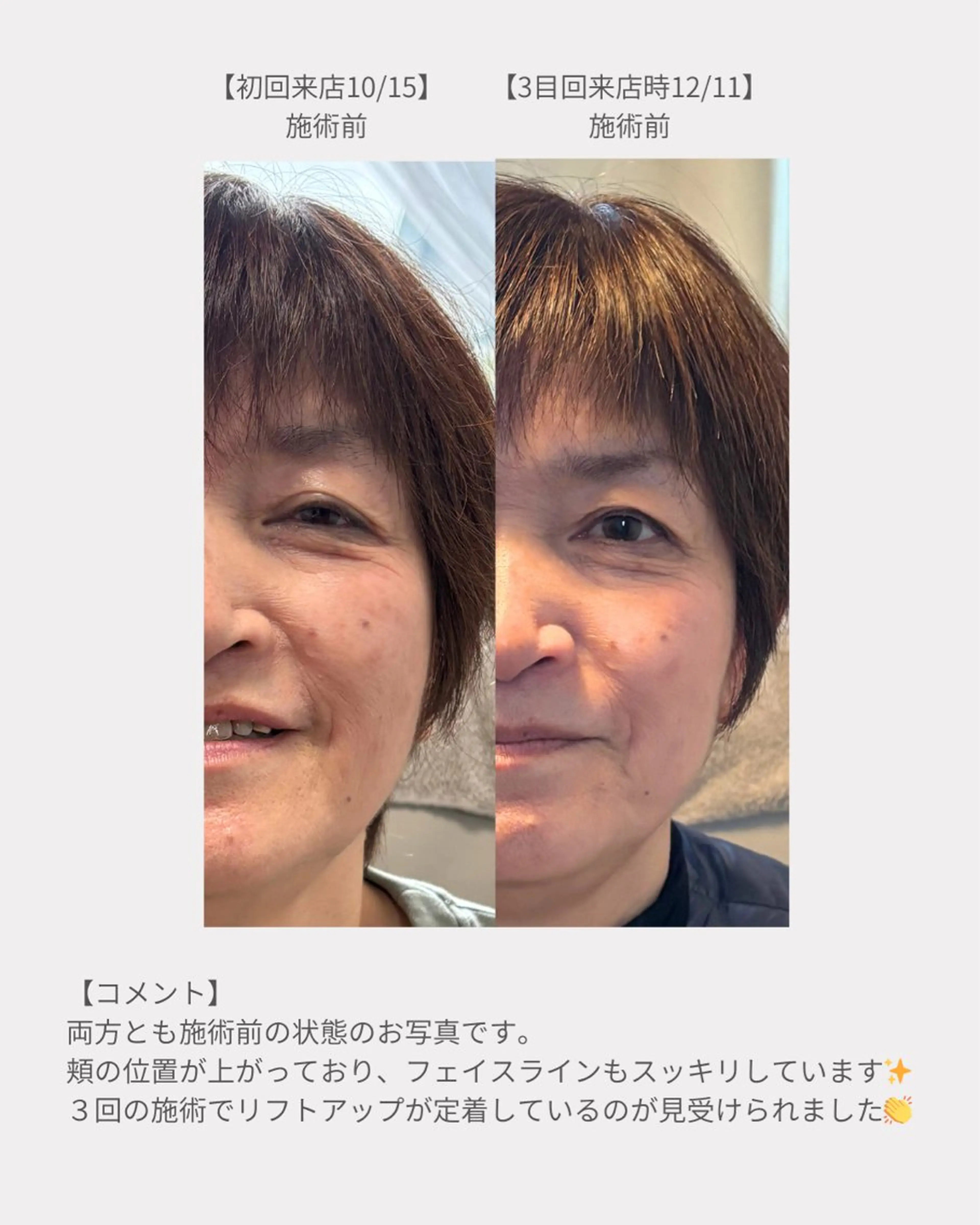 インナーの土台を整える3回ケア（モニター価格）の写真