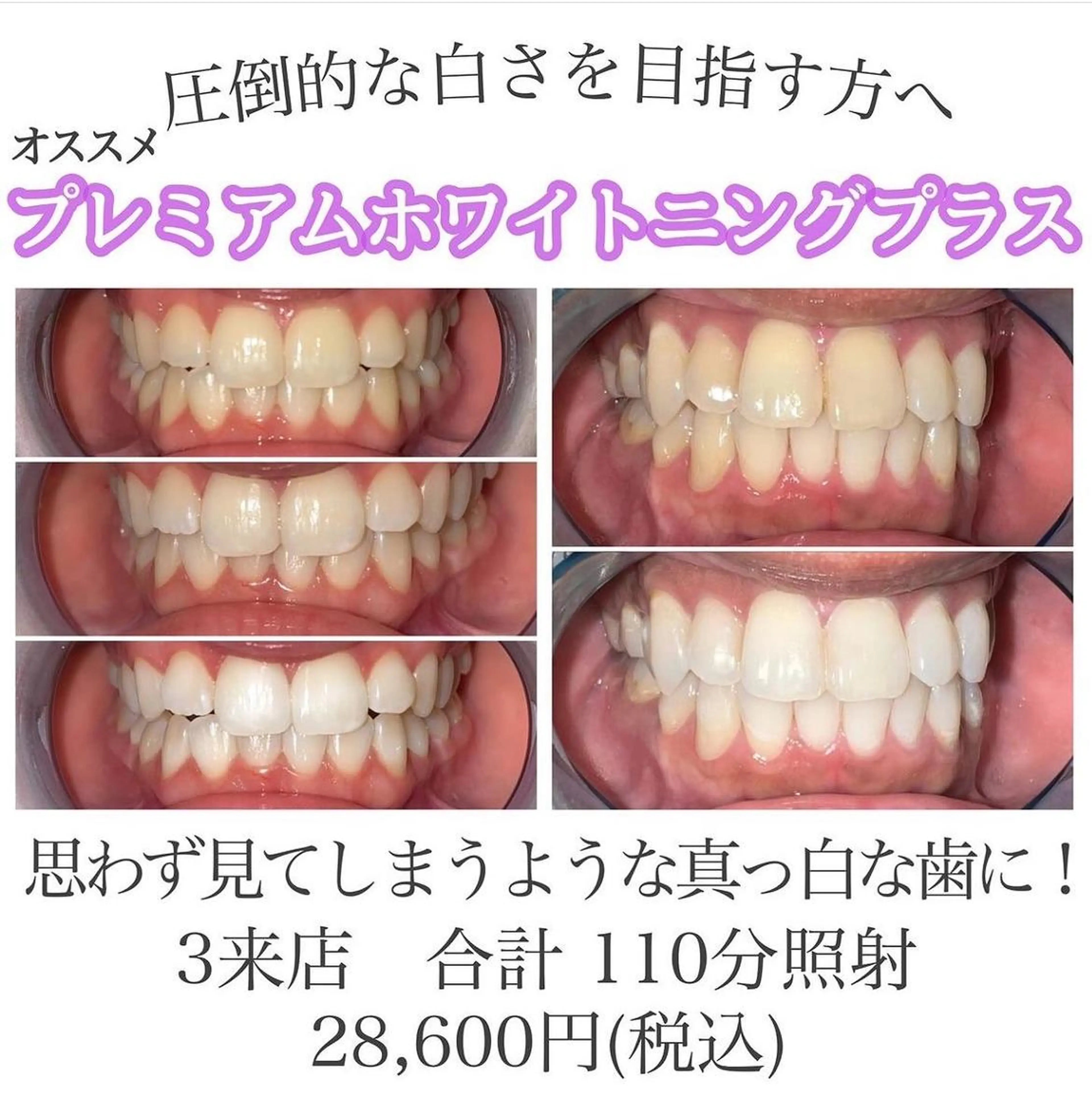【超お得】プレミアムホワイトニングプラス 3来店計110分照射 短期集中ホワイトニングケアに🦷✨の写真