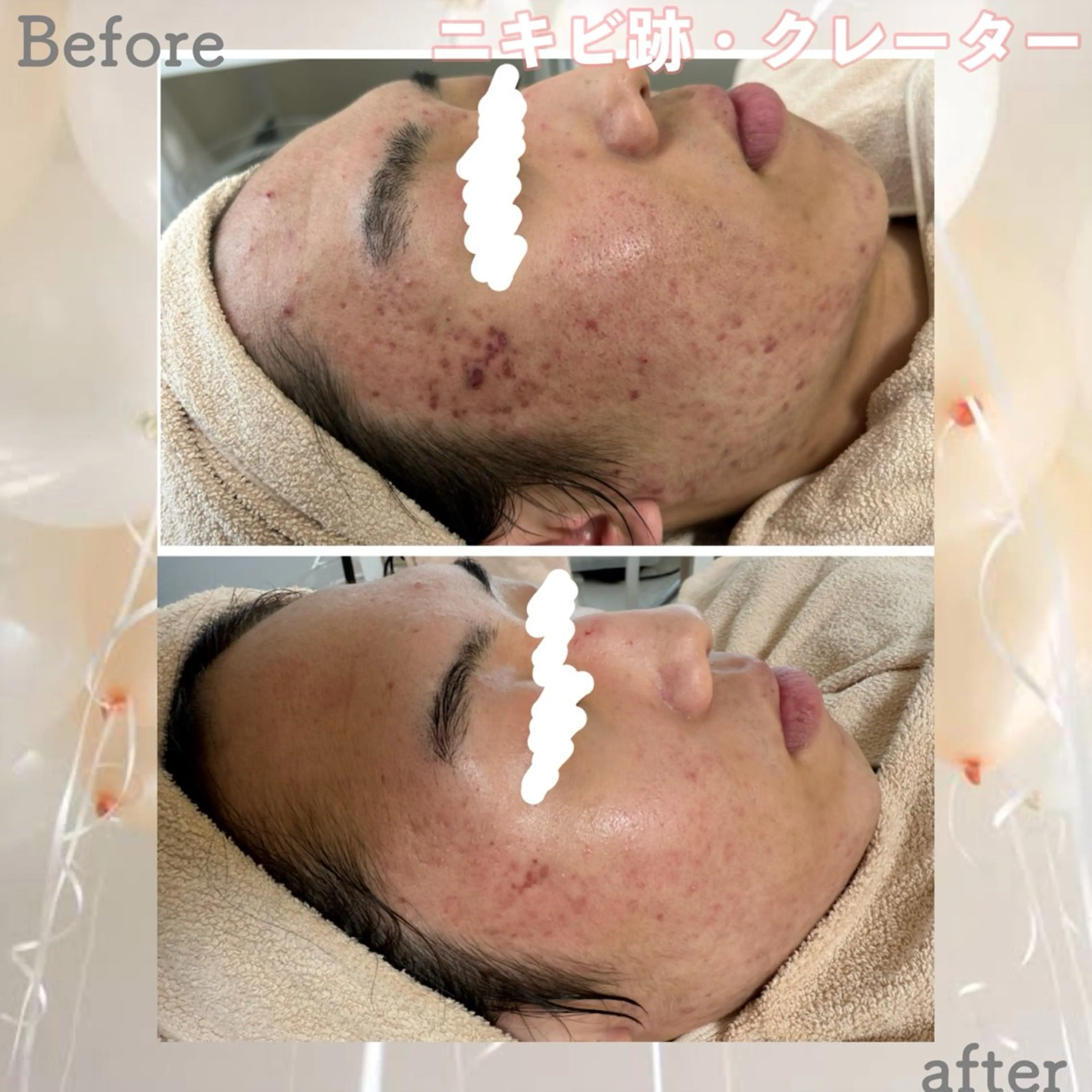 メンズ エステ ニキビ&跡改善サロン オーナー光木のエステ・リラクイメージ