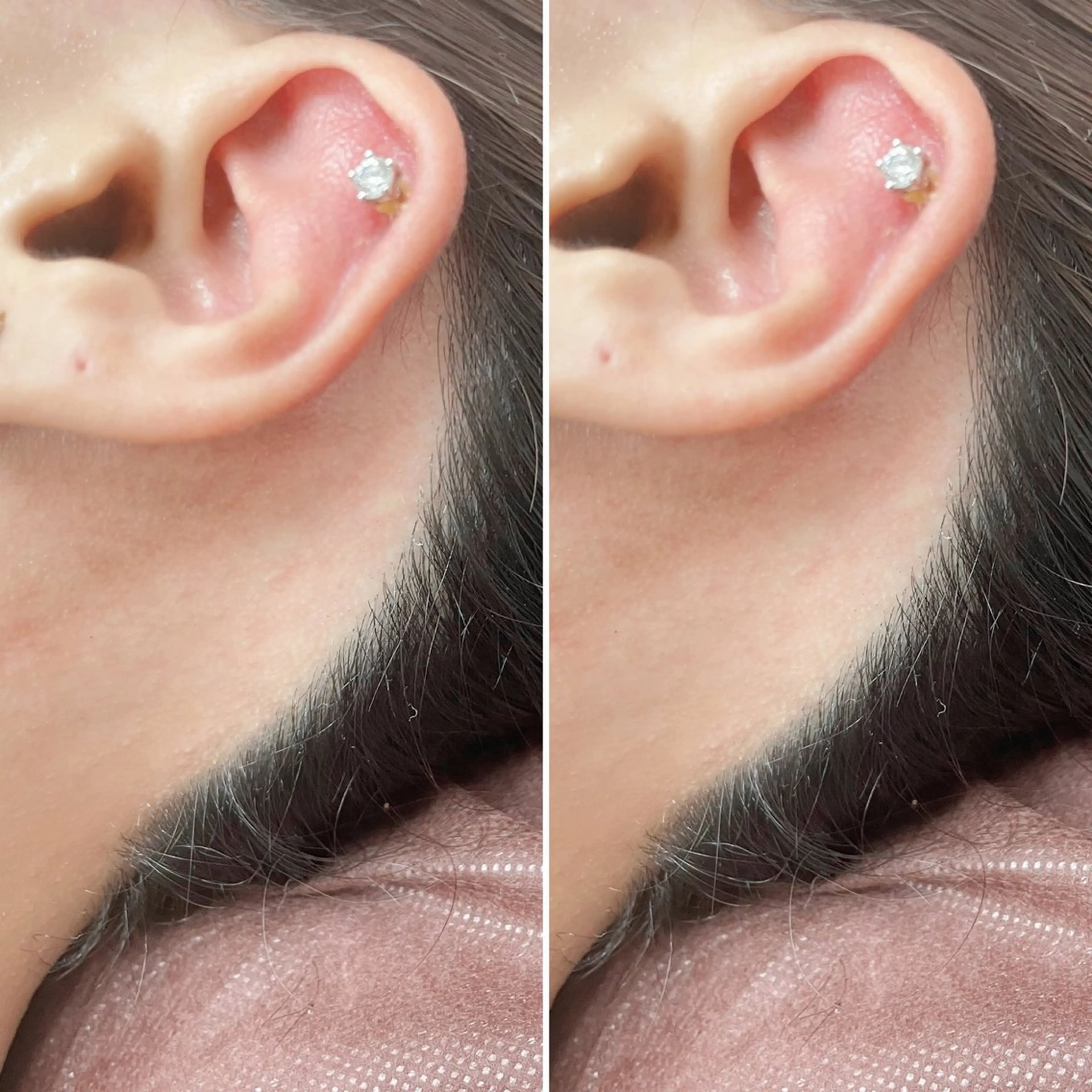 うなじWax脱毛の写真