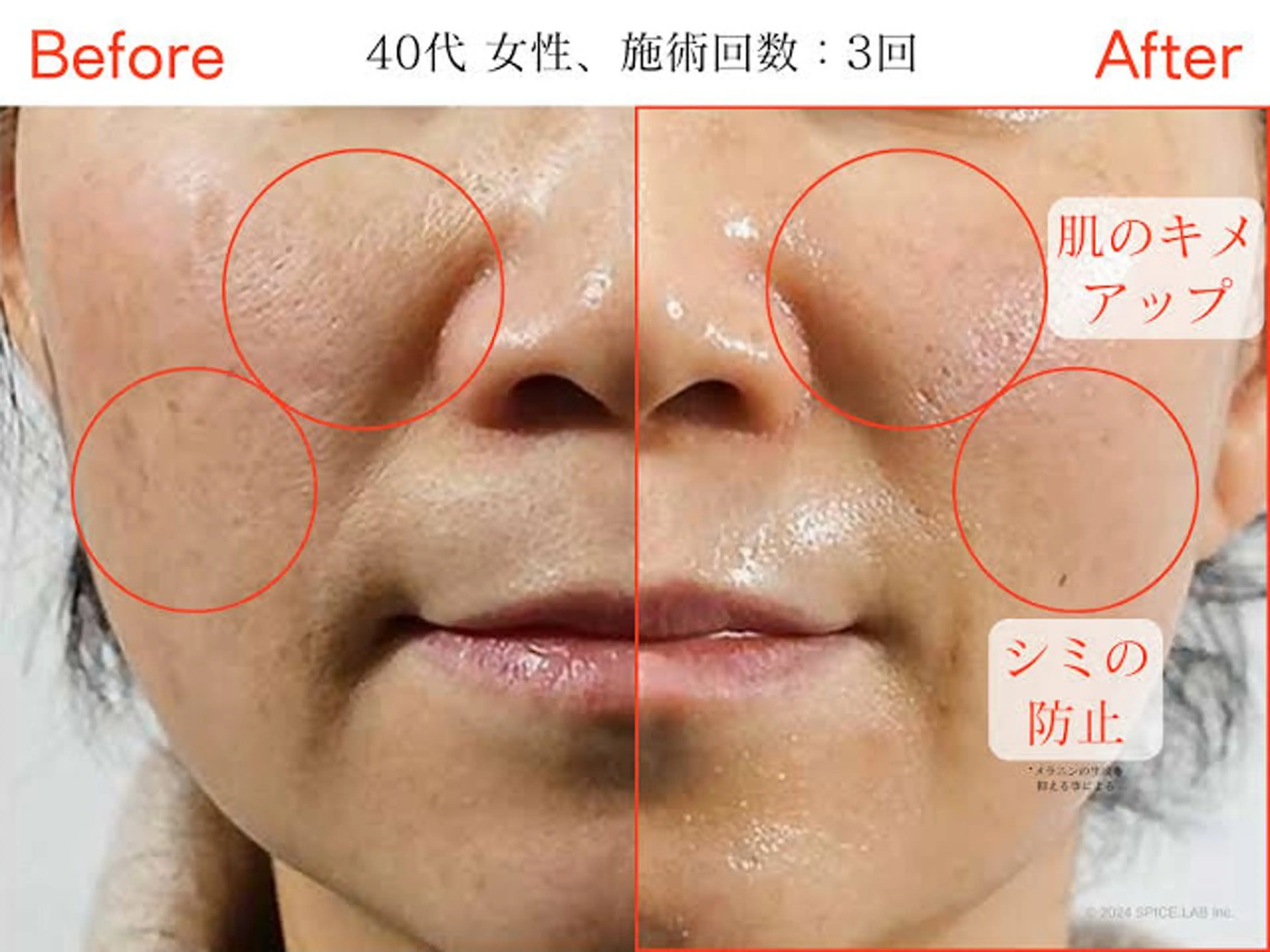 ララピール練習モデルの写真