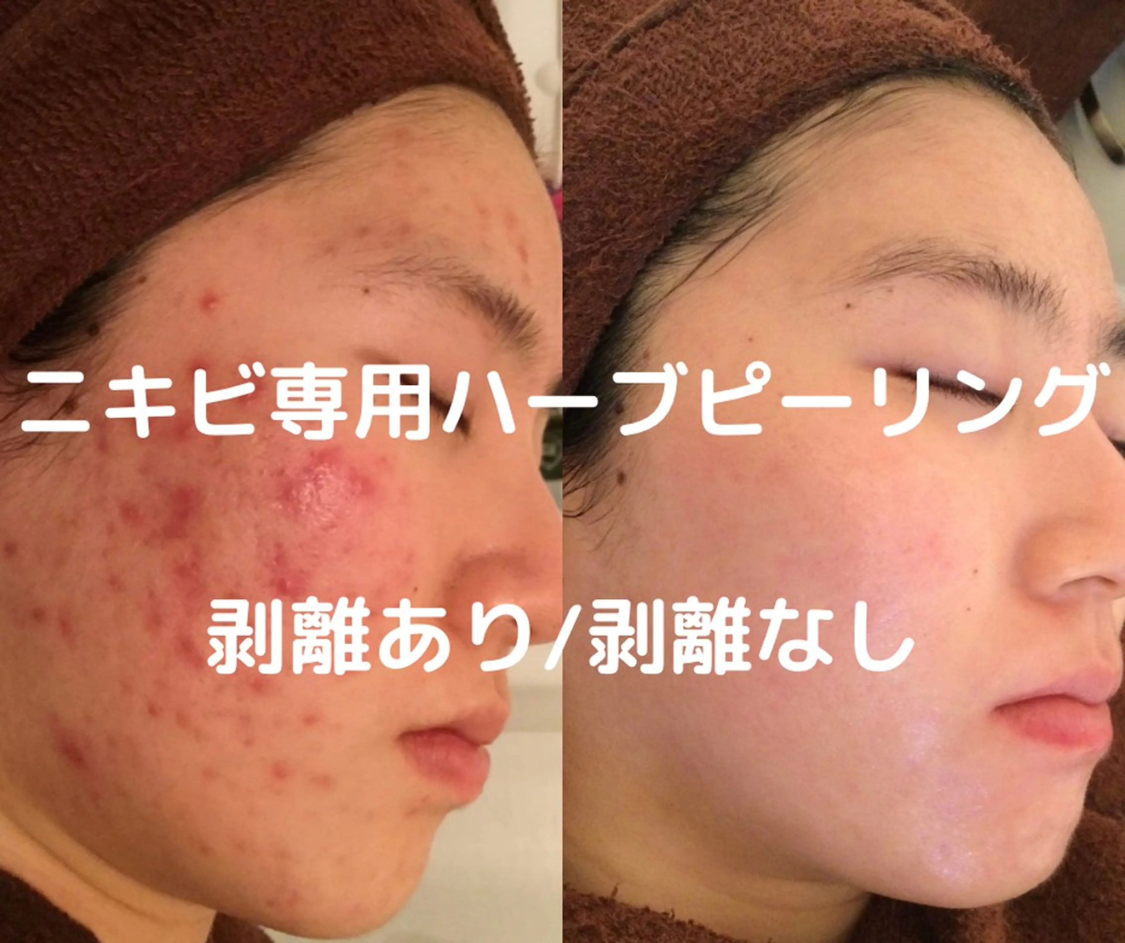 ニキビ/肌質改善専門 Snow skinのエステ・リラクイメージ