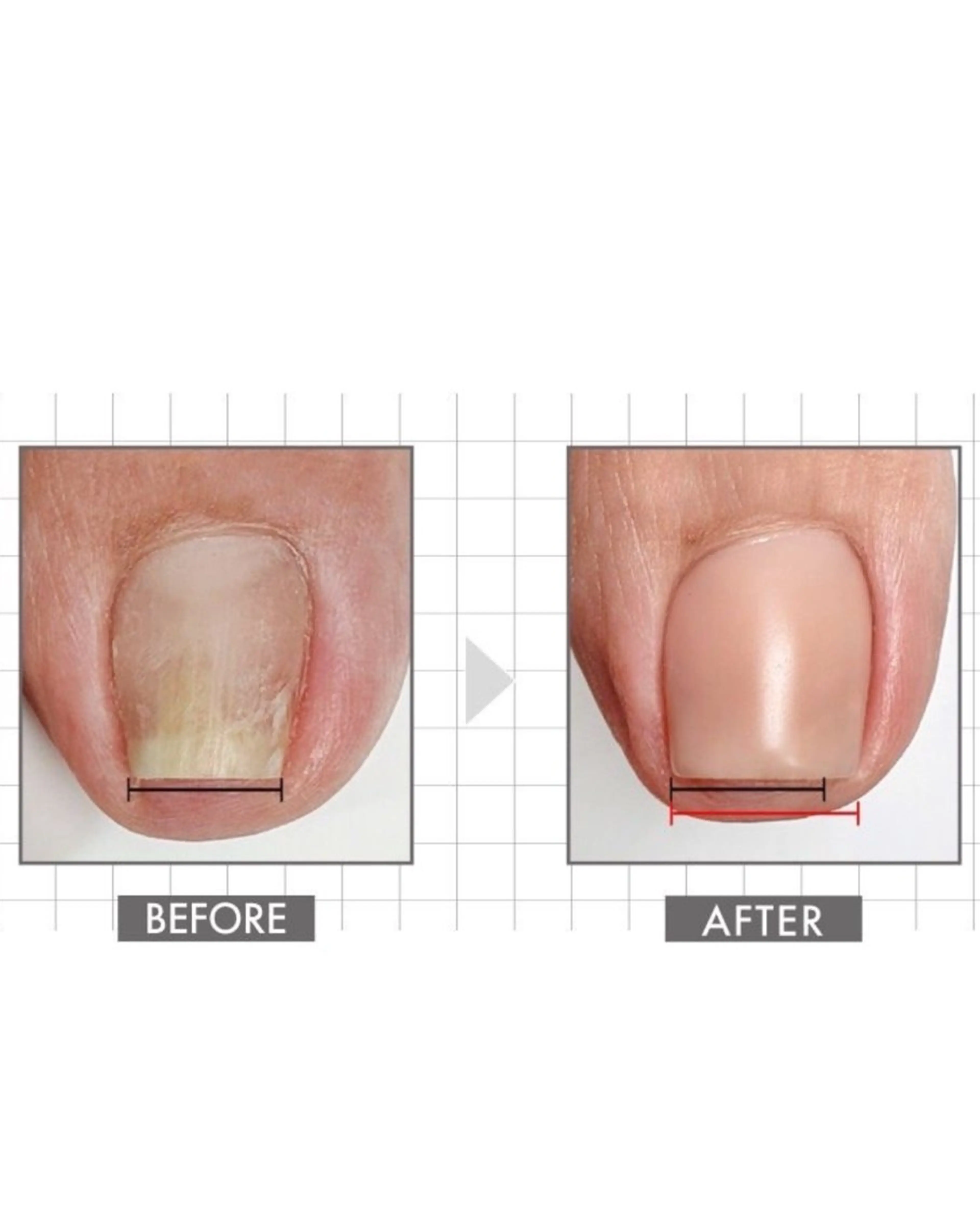 巻き爪ケア【ヘイスイッチ】の写真