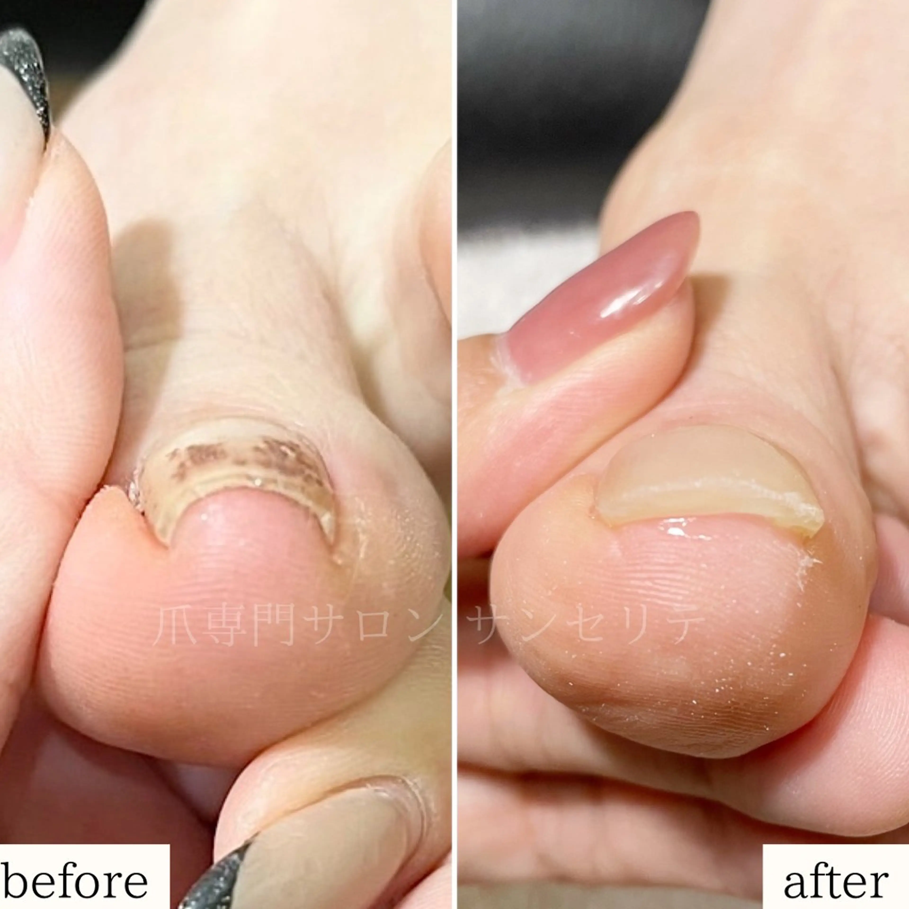 ネイル 深爪・巻き爪 専門サンセリテのネイルデザイン