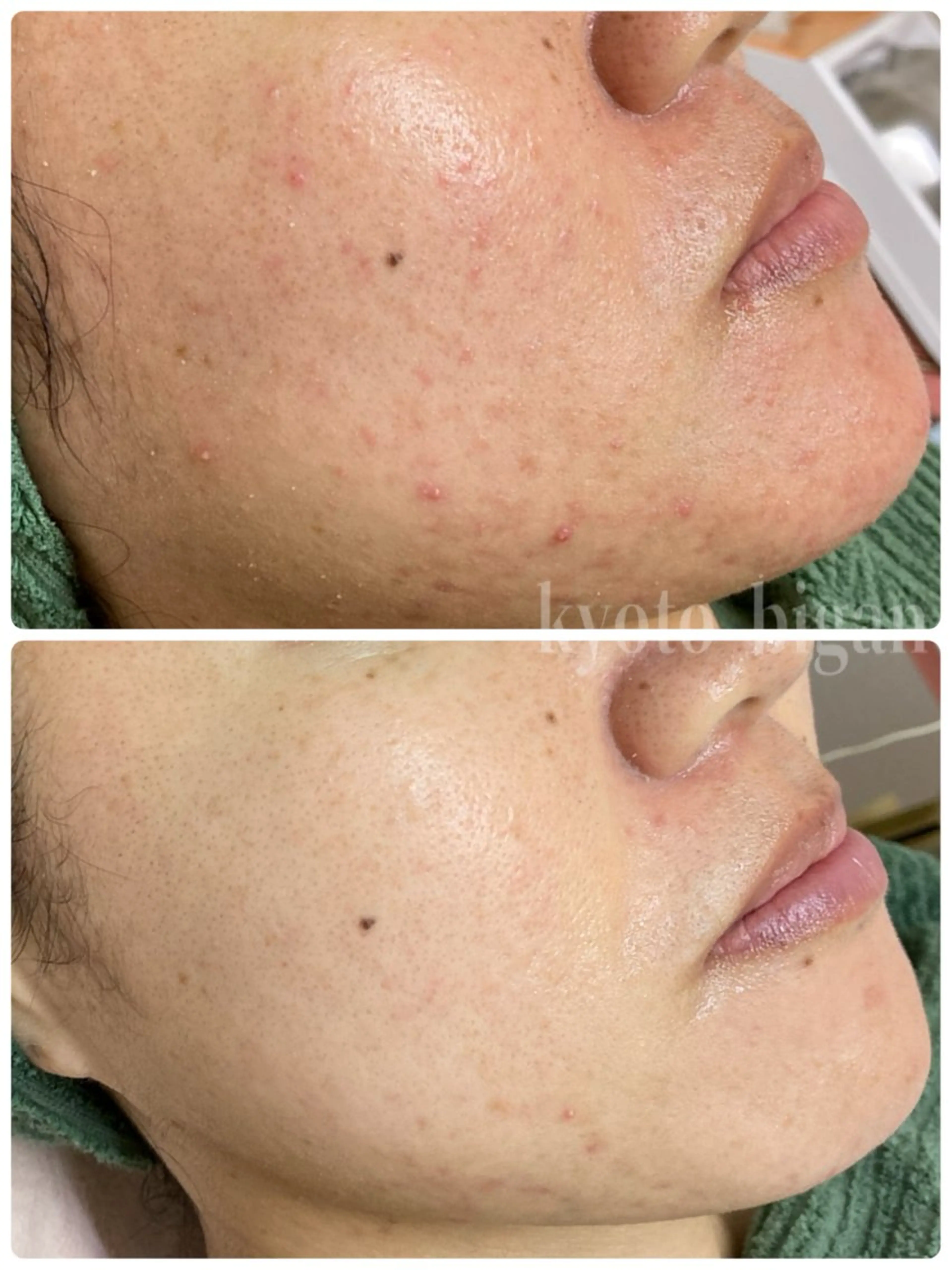 ６月限定⭐️平日9​〜​12時限定　癒しのフェイシャルトリートメント体験の写真