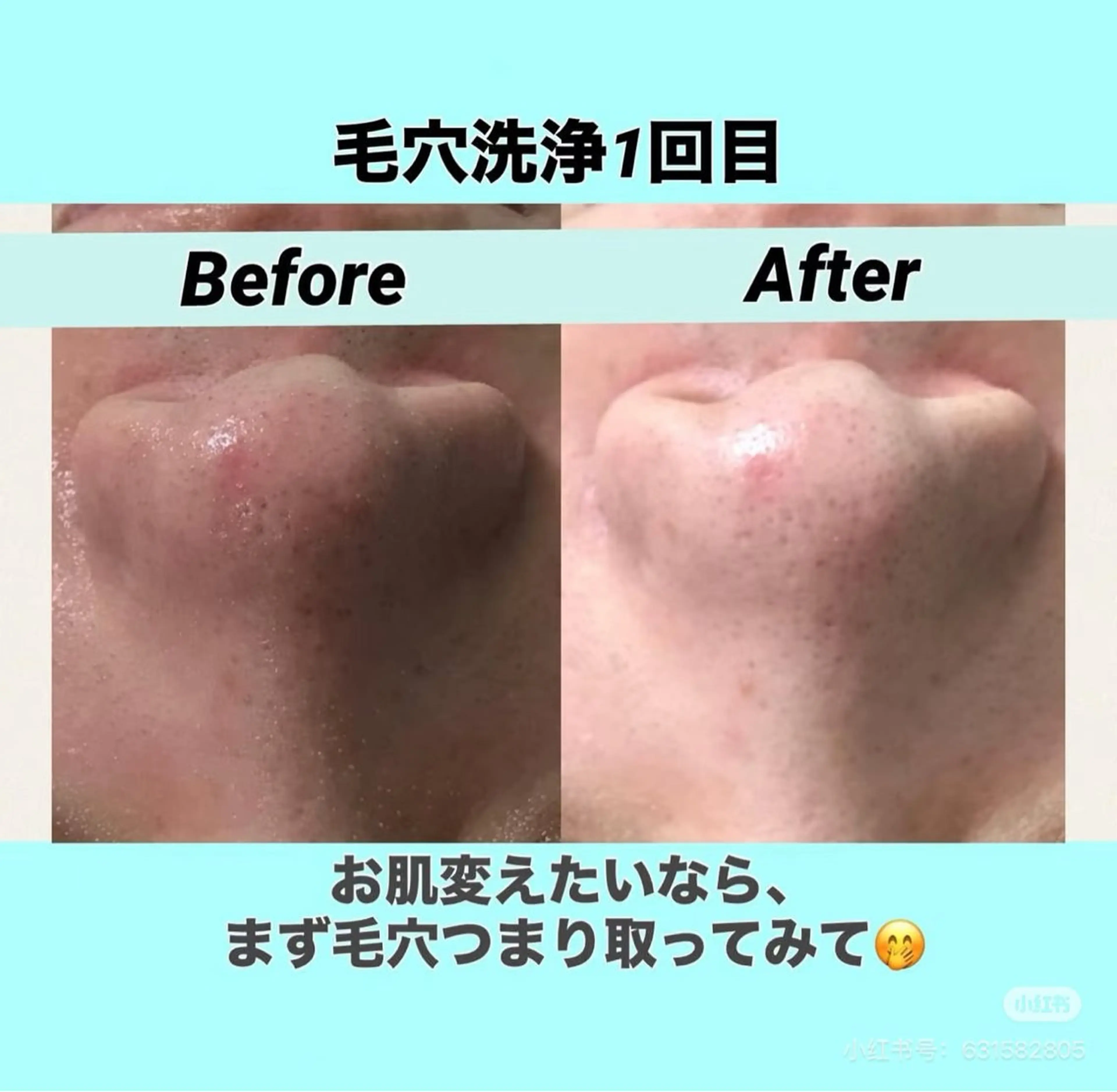 フェシャル★お試しモニター価額9350円 →5000円〇毛穴ケア人気NO.1超音波毛穴洗浄+ビタミン導入★条件有りの写真