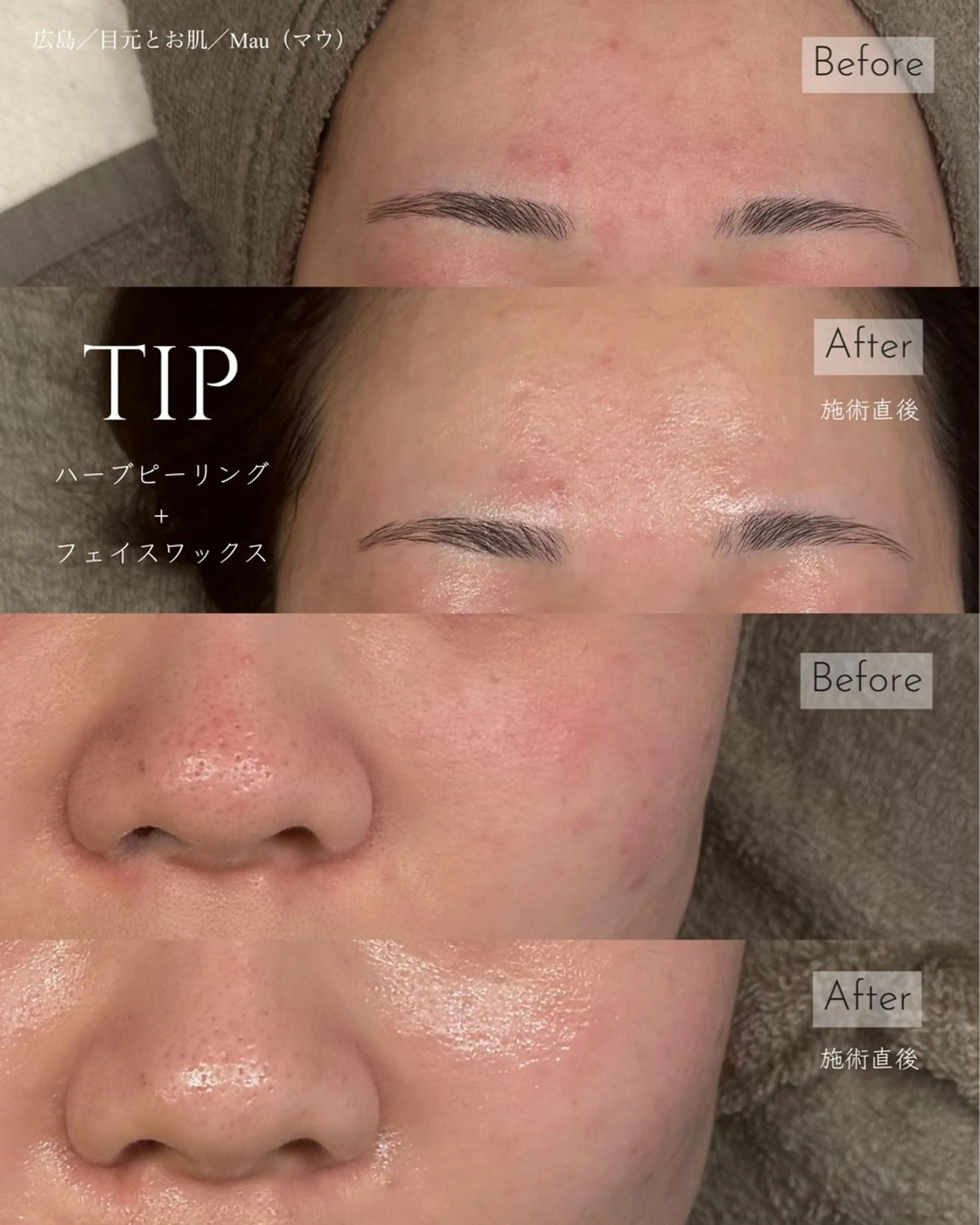 【ニキビケア】-お肌に優しいハーブピーリングで健康的な艶肌に🌿剥離せず、ダウンタイムもありませんの写真