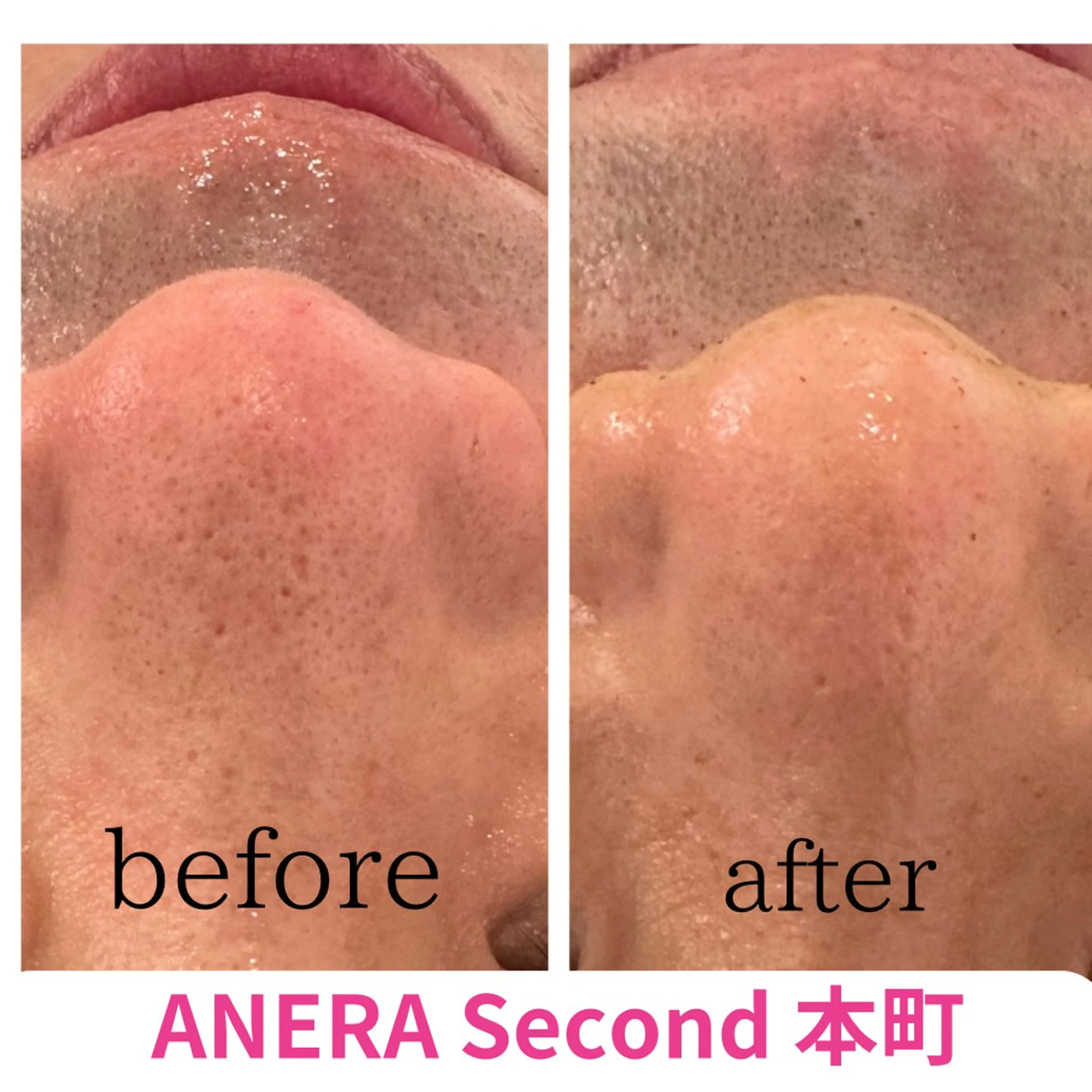 【メンズ限定】男前は作れる★小顔矯正&ハイドロスプラッシュ毛穴洗浄8,900円の写真