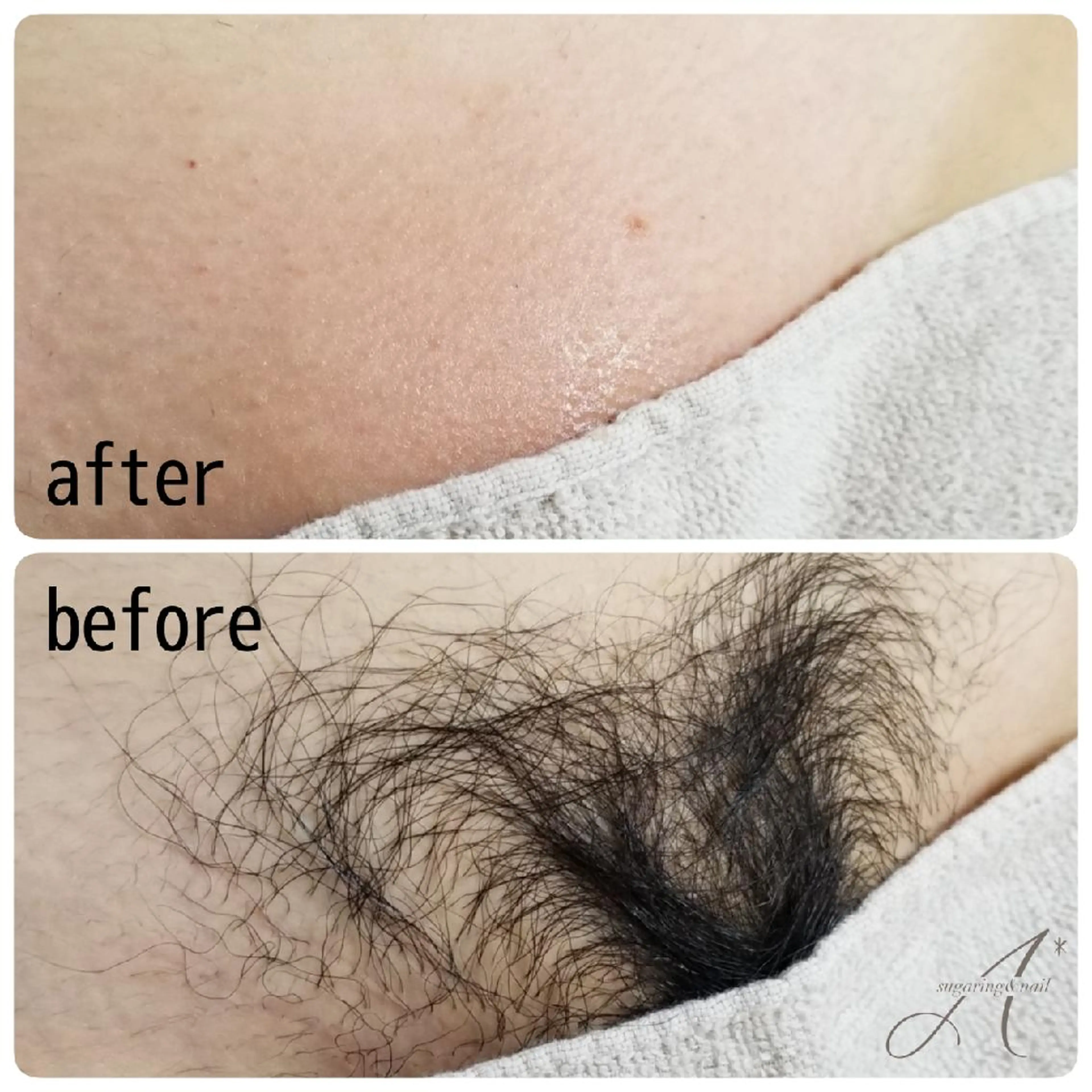 【2番人気🌟】VIO脱毛🍋シュガーリングの写真