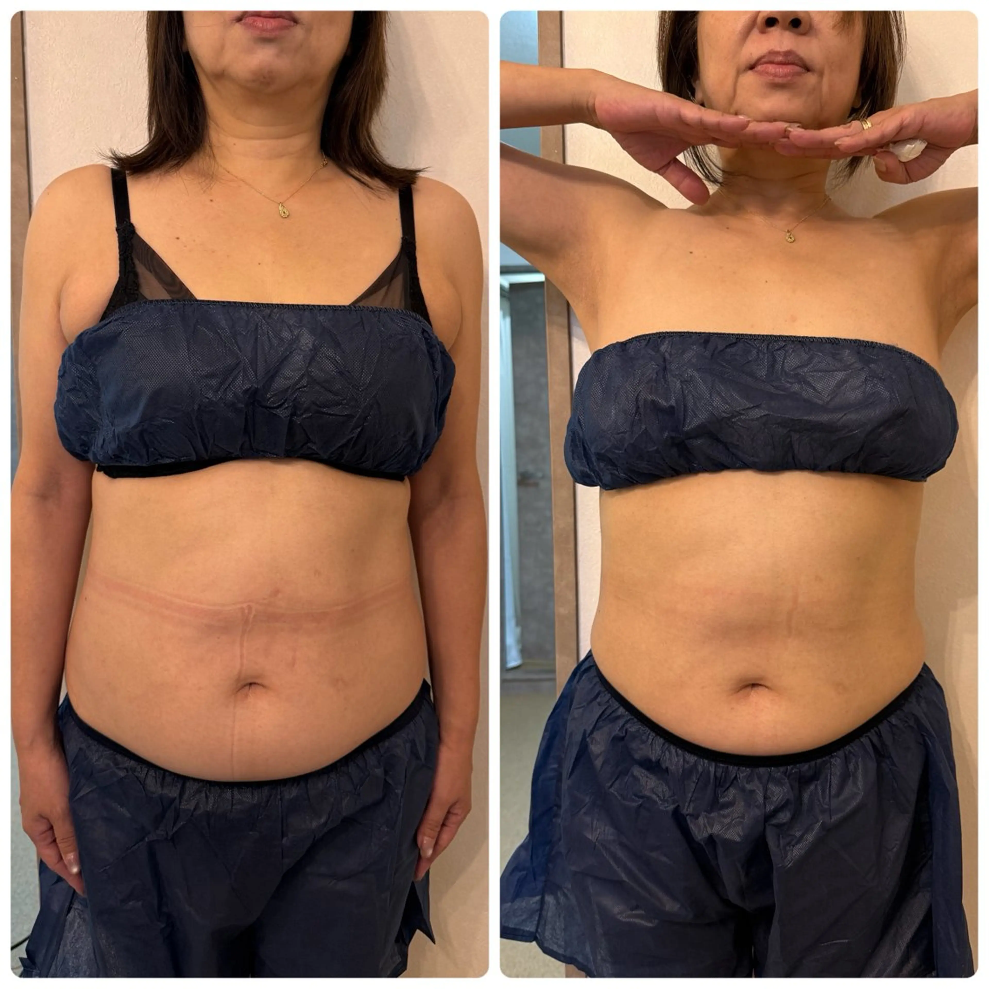 【好きな部位が選べる】ラジオ派✕超音波✕脂肪気になる部位に♪初回限定¥4,400の写真