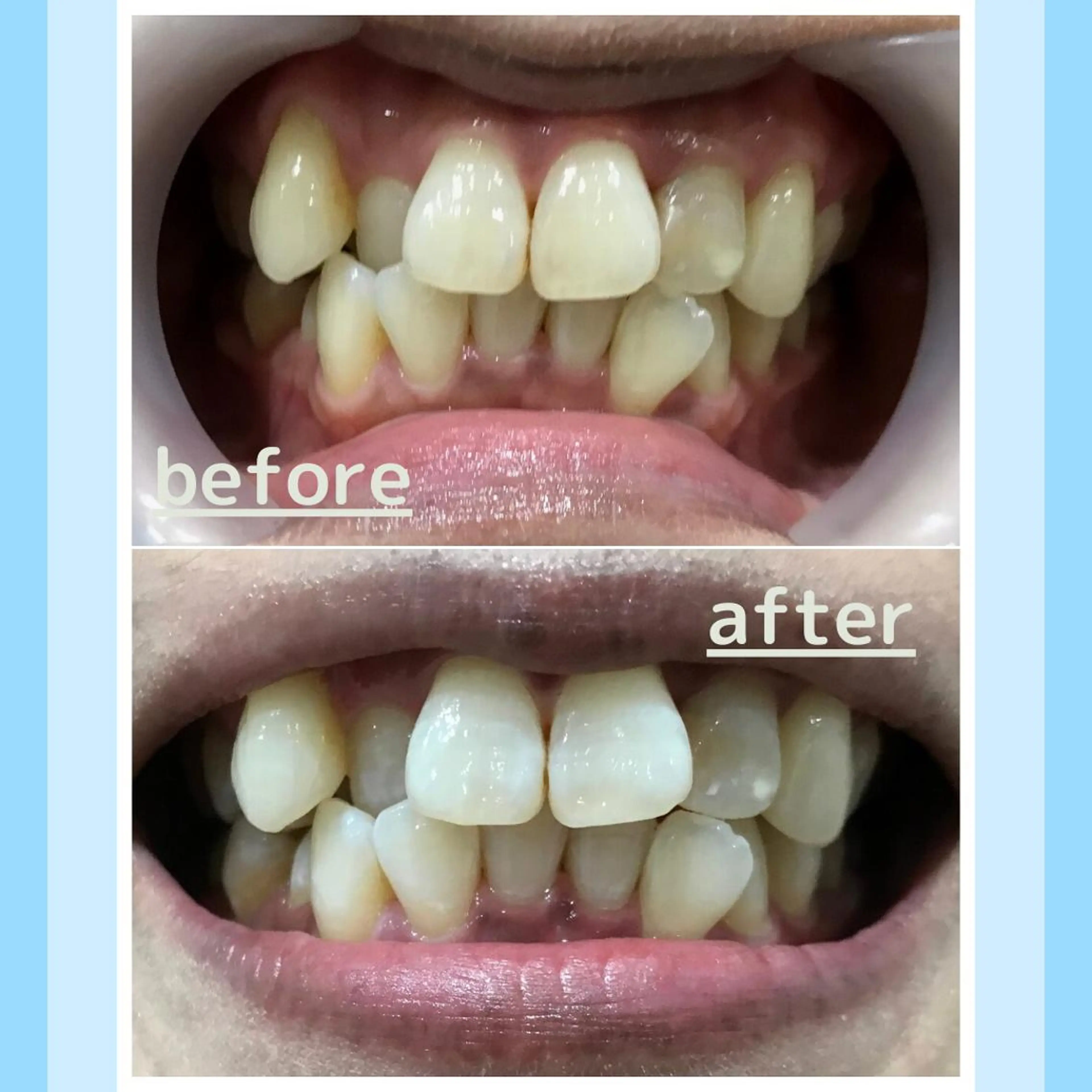 メンズ クリスマス お手軽ホワイトニングsalon mina所属・武元 奈津美のその他イメージ