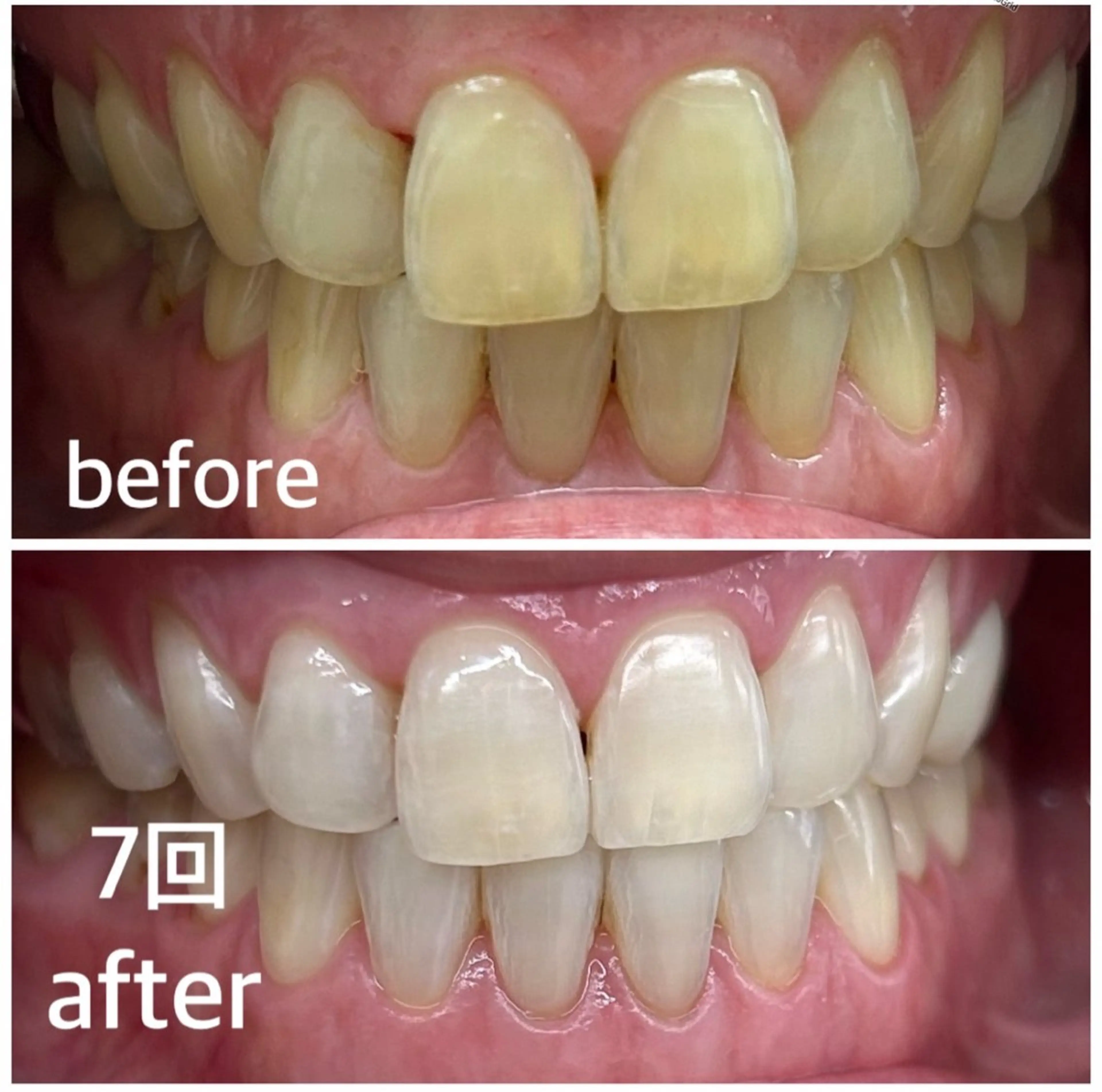 『お試し!結果に自信!歯科衛生士×医療提携!白くなる歯のセルフホワイトニング』🦷✨の写真