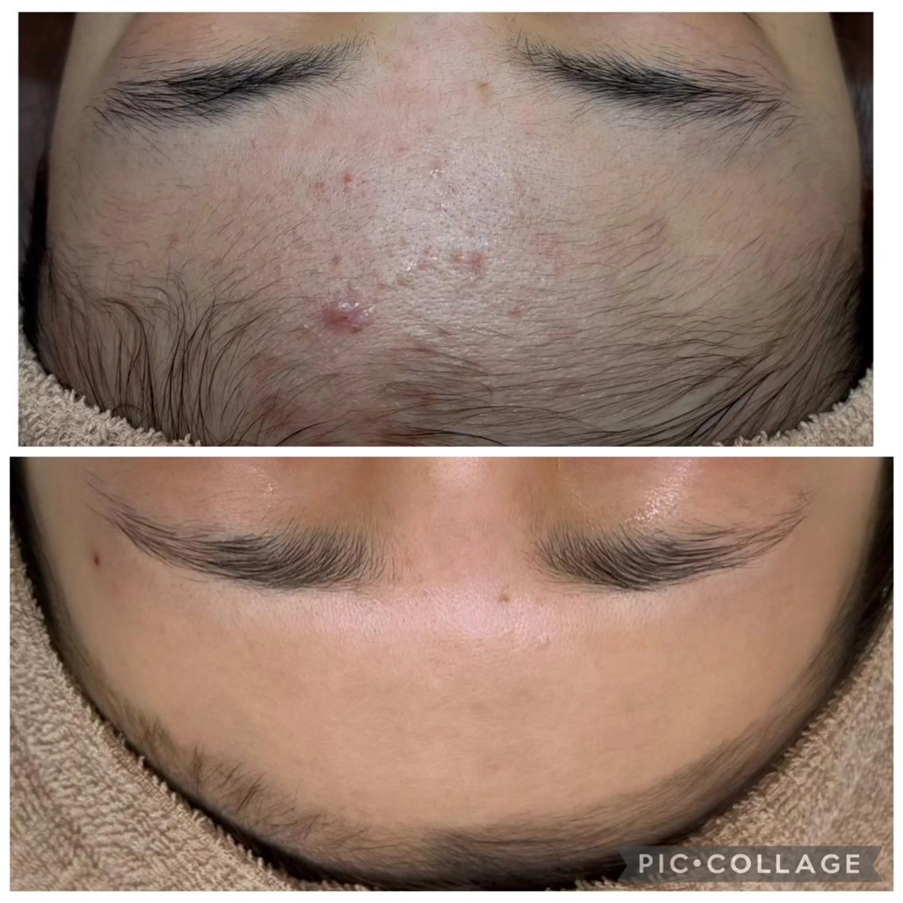 本日限定❣️脱眉毛wax⁉️シェービング付全顔脱毛✨眉毛美人に❣️5回でこの効果!目指せノーファンデ肌❣️の写真