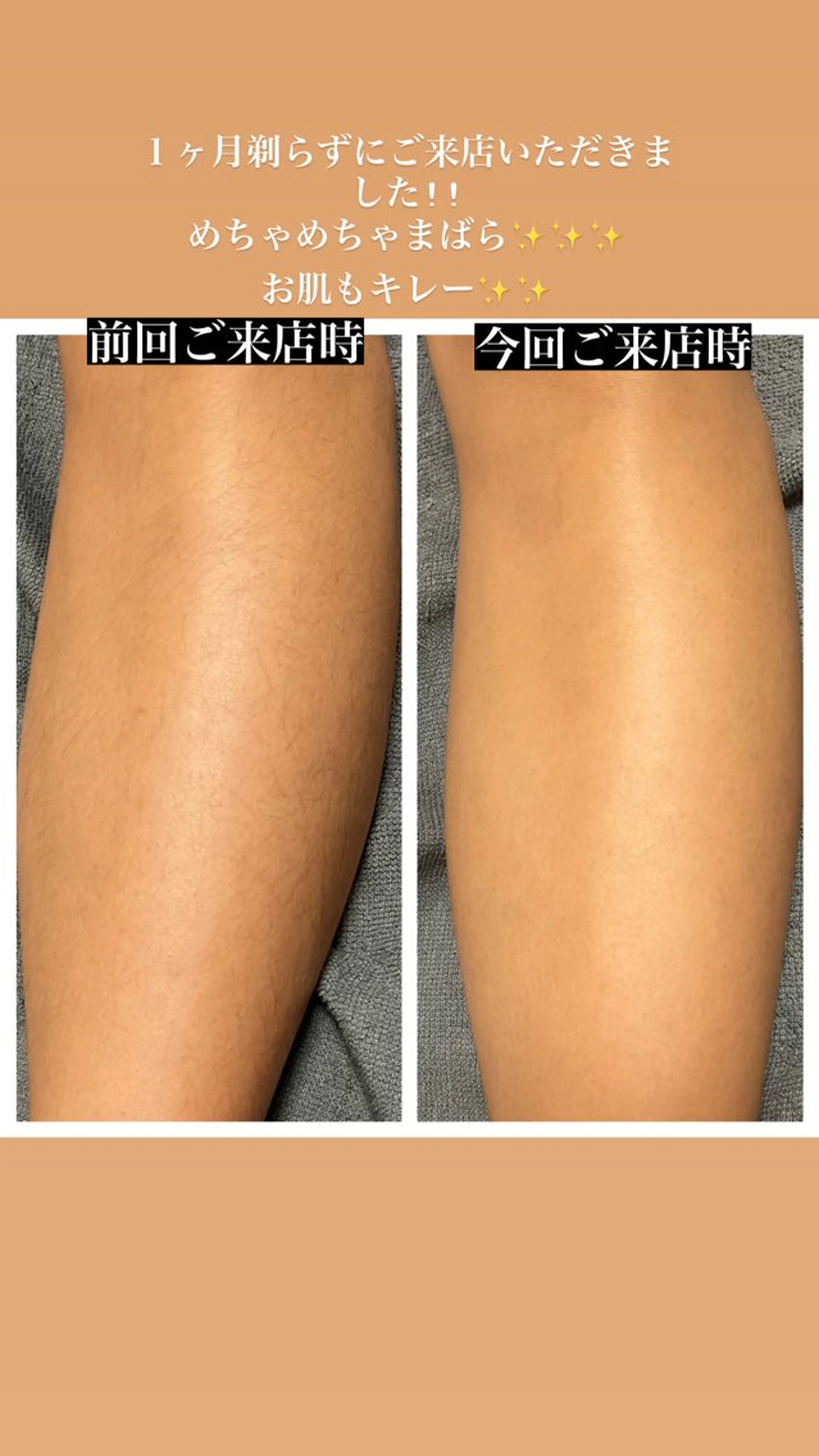 woman 全身脱毛(顔・vio除く)の写真