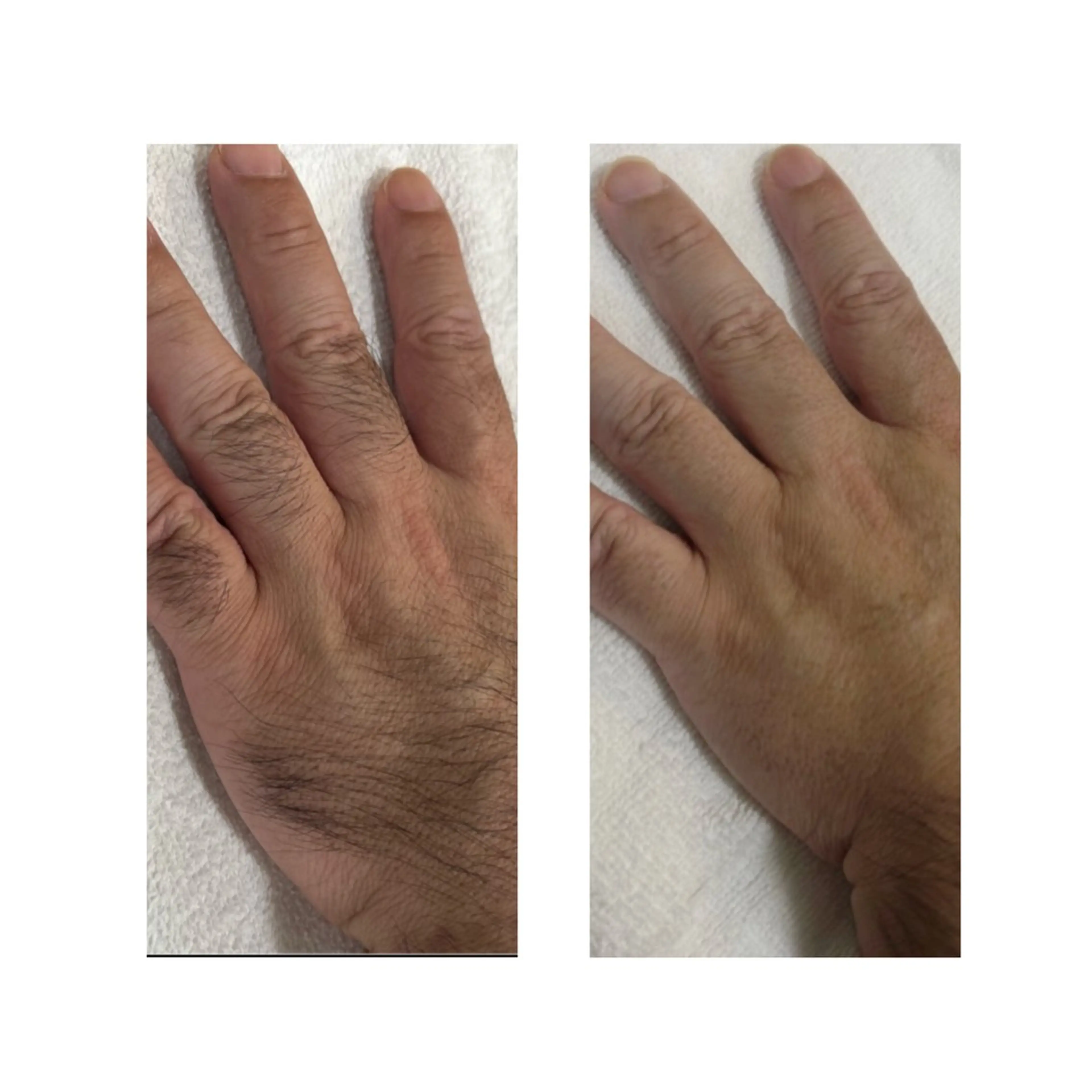💎脱毛 手の甲・指のみの写真