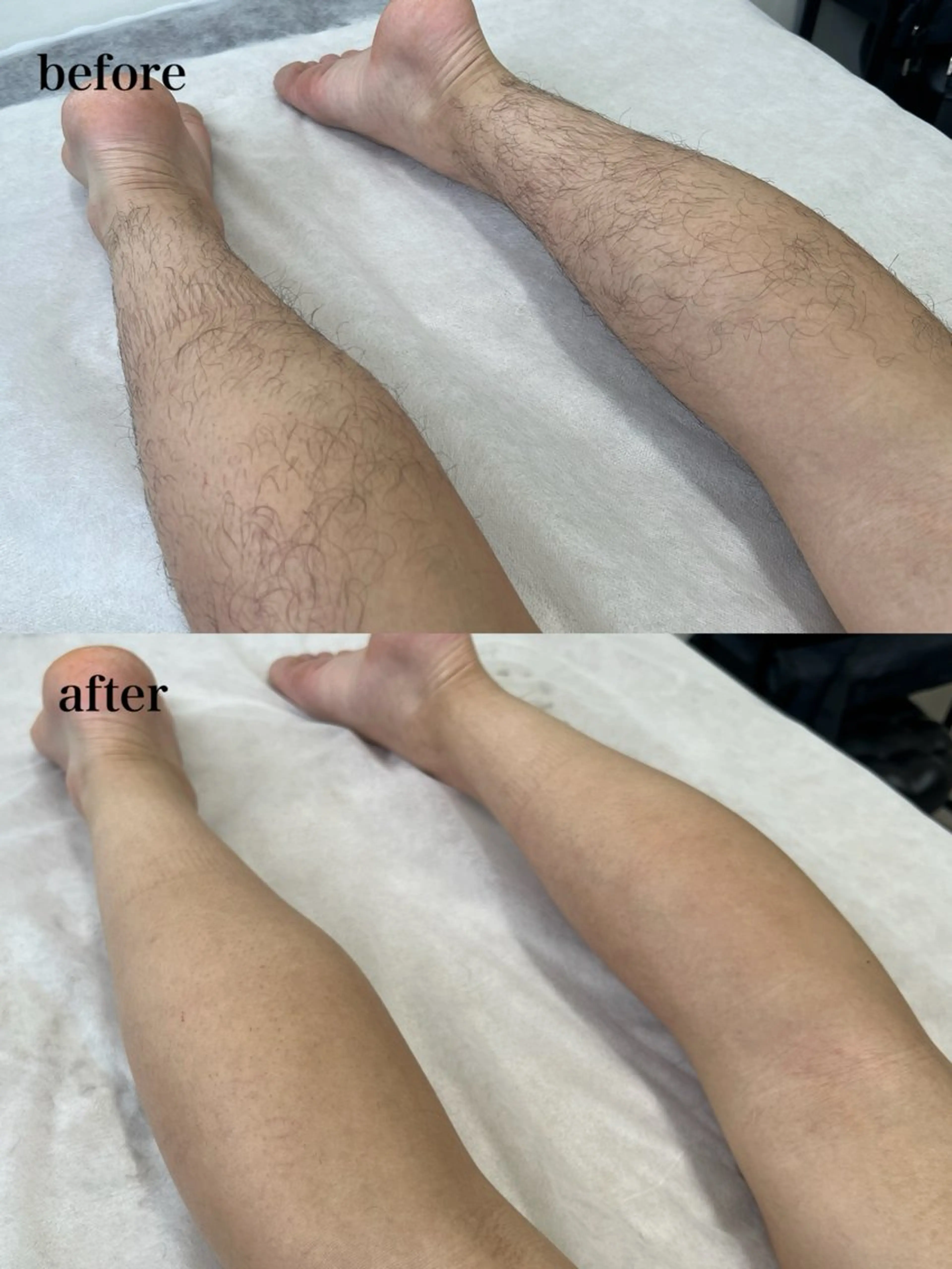 【2回目からのお客様✨】【脱毛1箇所】{顔・うなじ・お腹・背中・両腕・両足｝お好きな箇所選んでいただけます♪の写真