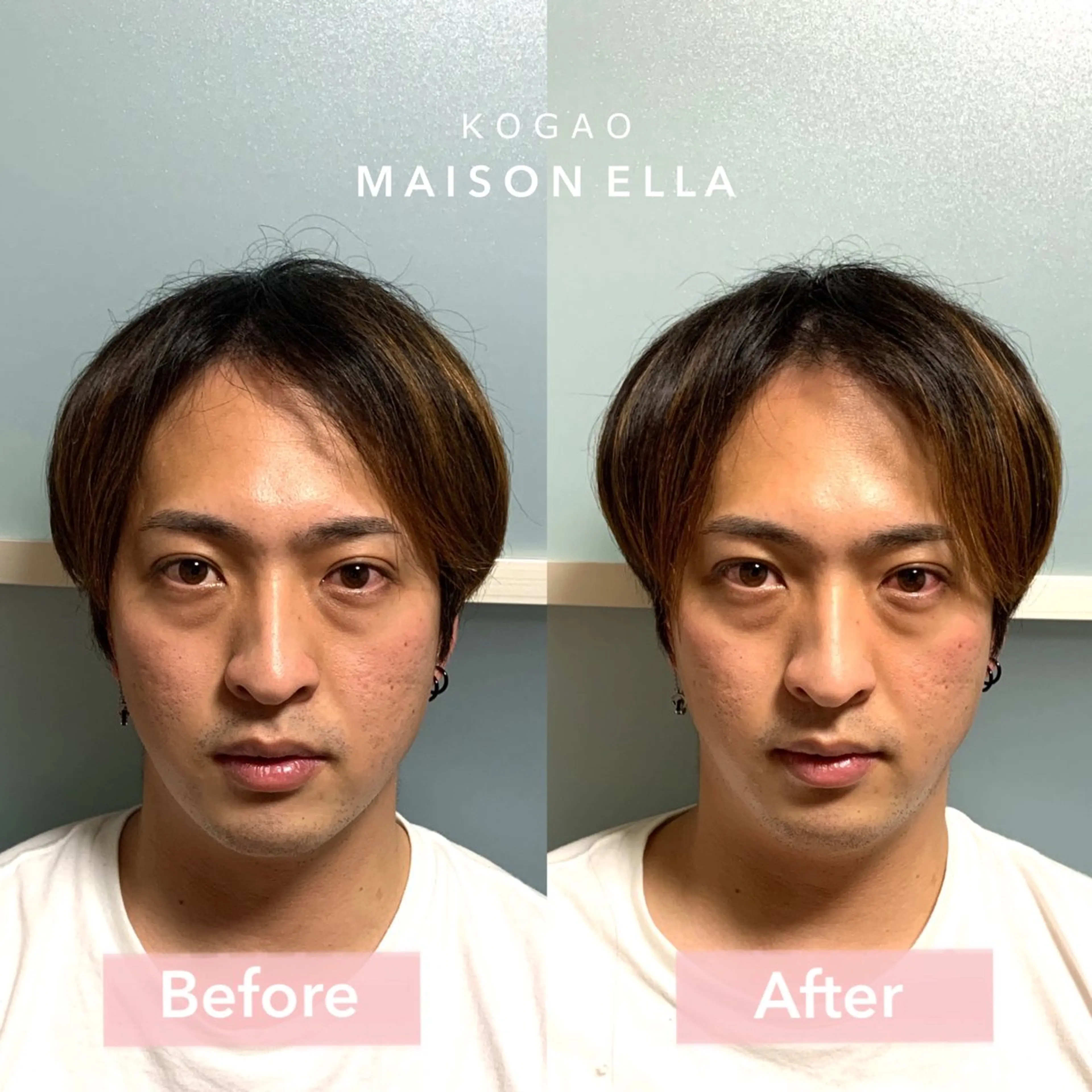 ⭐️小顔矯正モニター様募集⭐️目隠しナシで顔出しOKな方専用メニューの写真