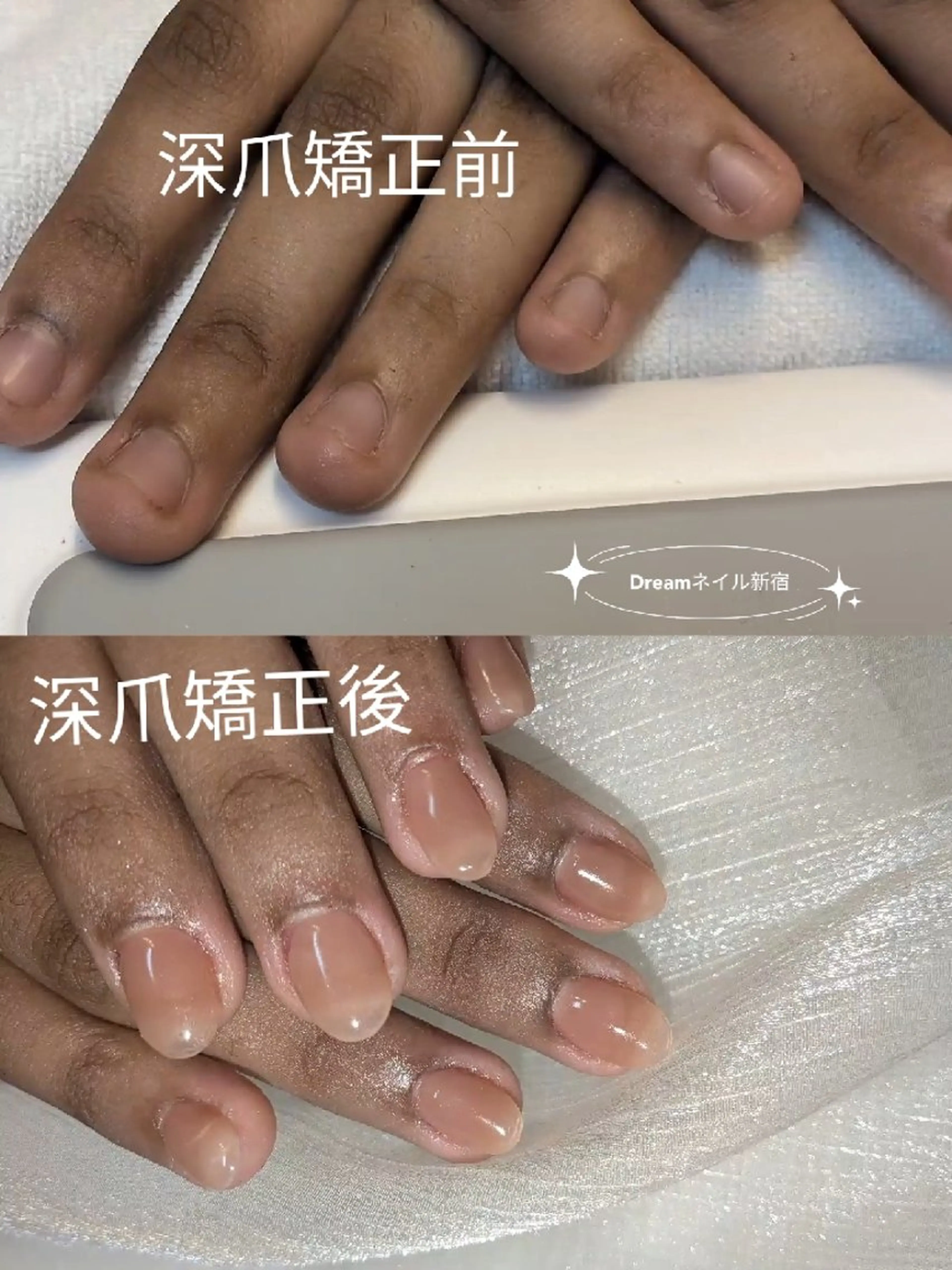ネイル ネイリストゆか💅 長さだし、深爪矯正のネイルデザイン
