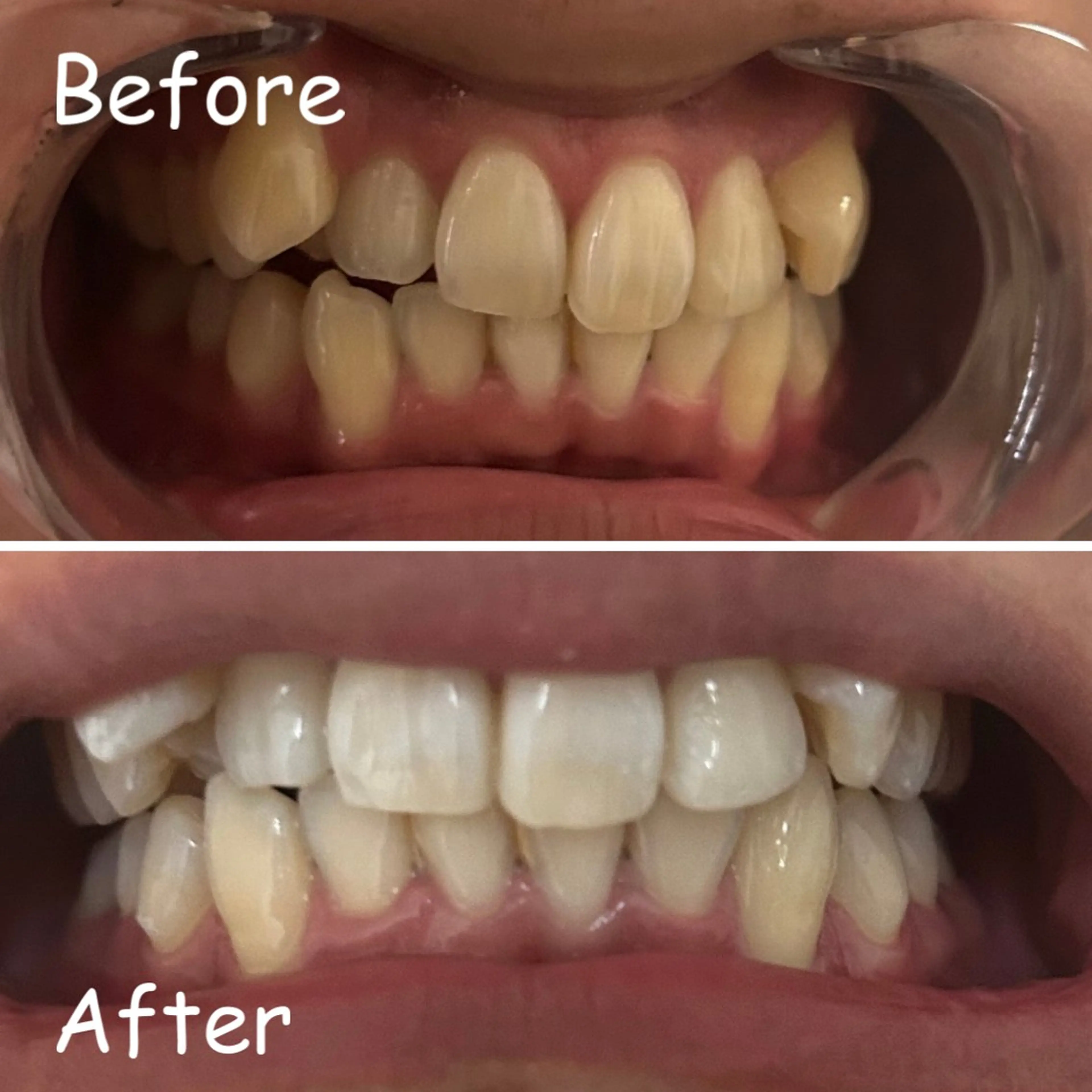 【2回目以降】セルフホワイトニング 2000の写真