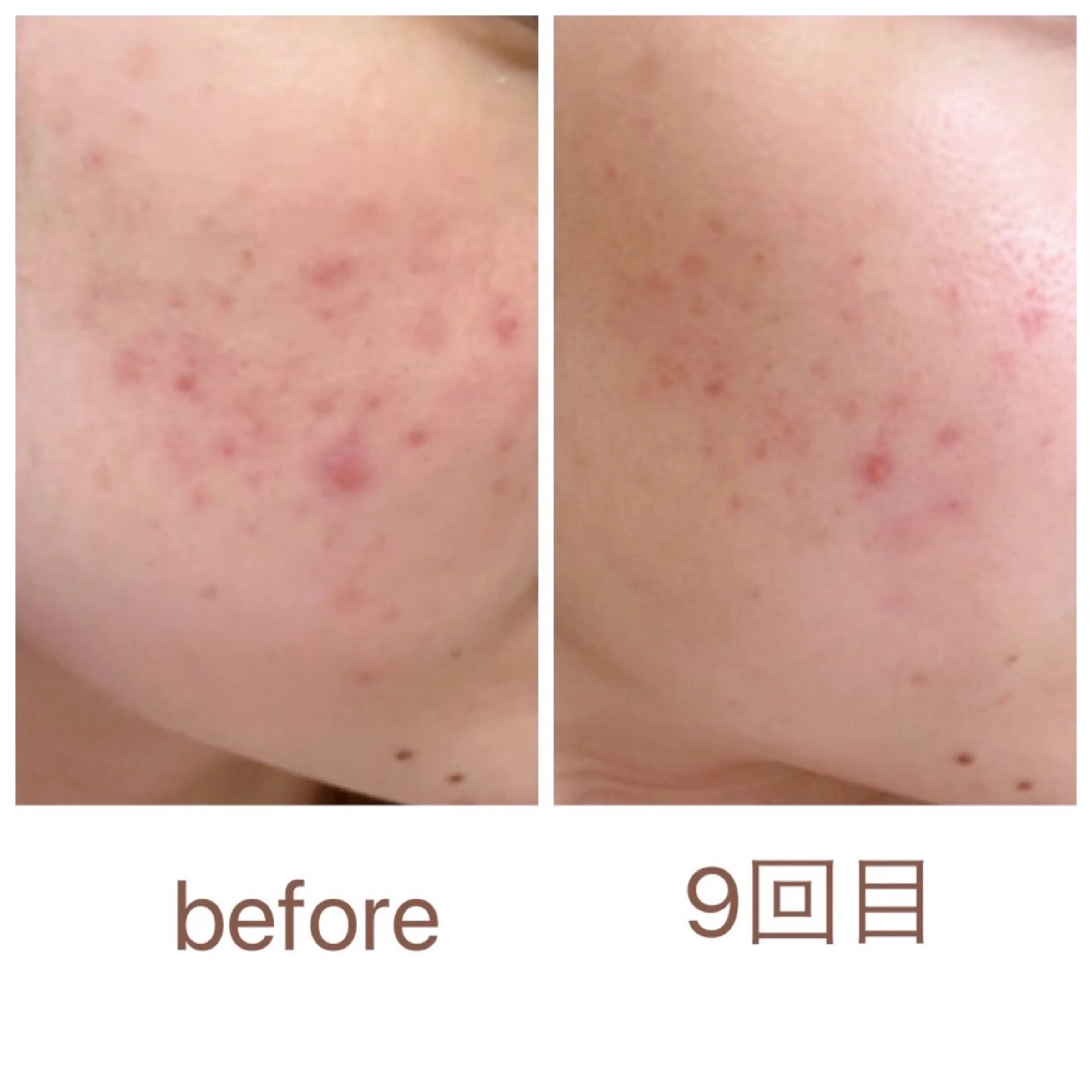 美容鍼【肌質改善】の写真