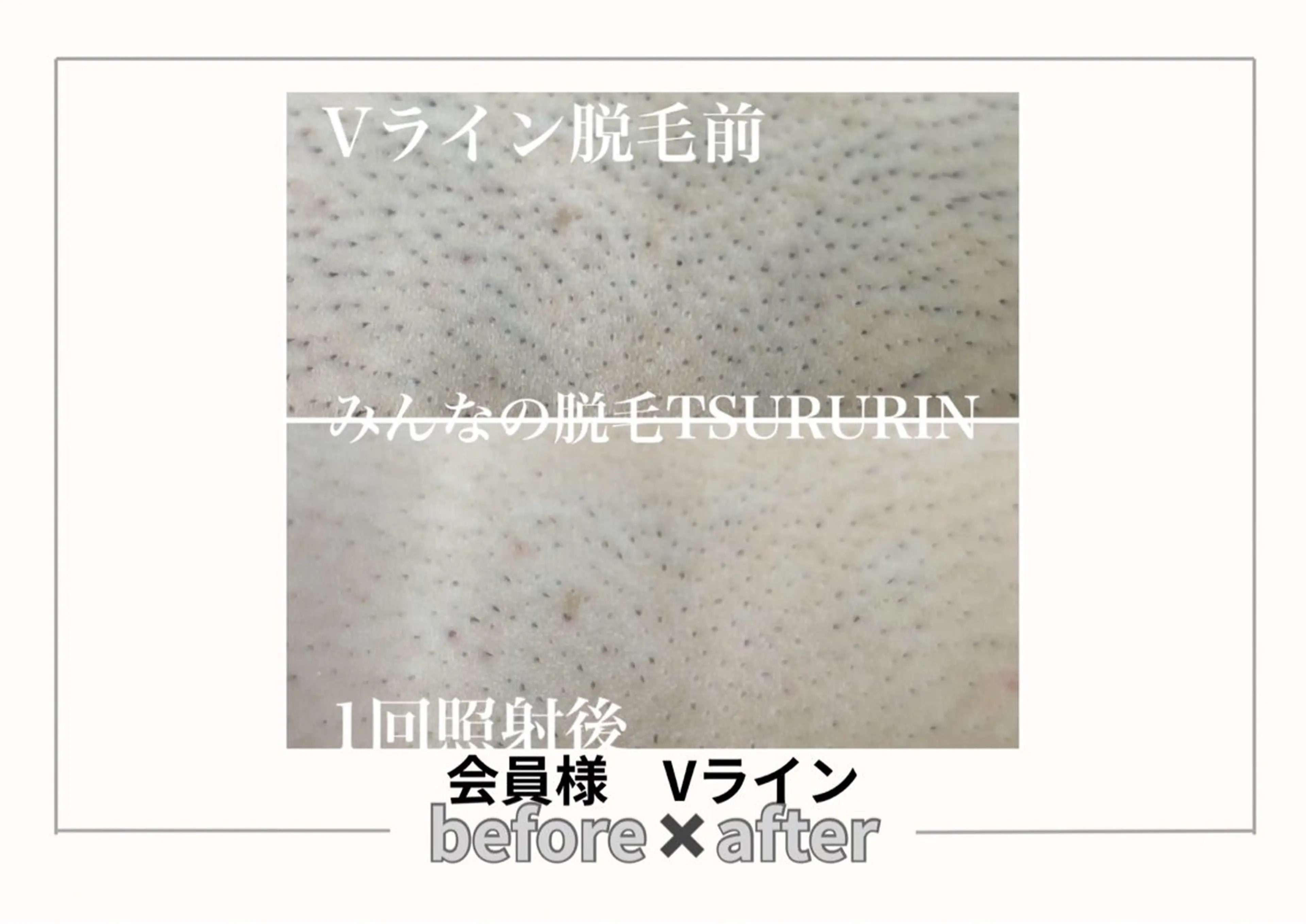 脱毛 みんなの脱毛ツルリン ☀️船橋店☀️のエステ・リラクイメージ