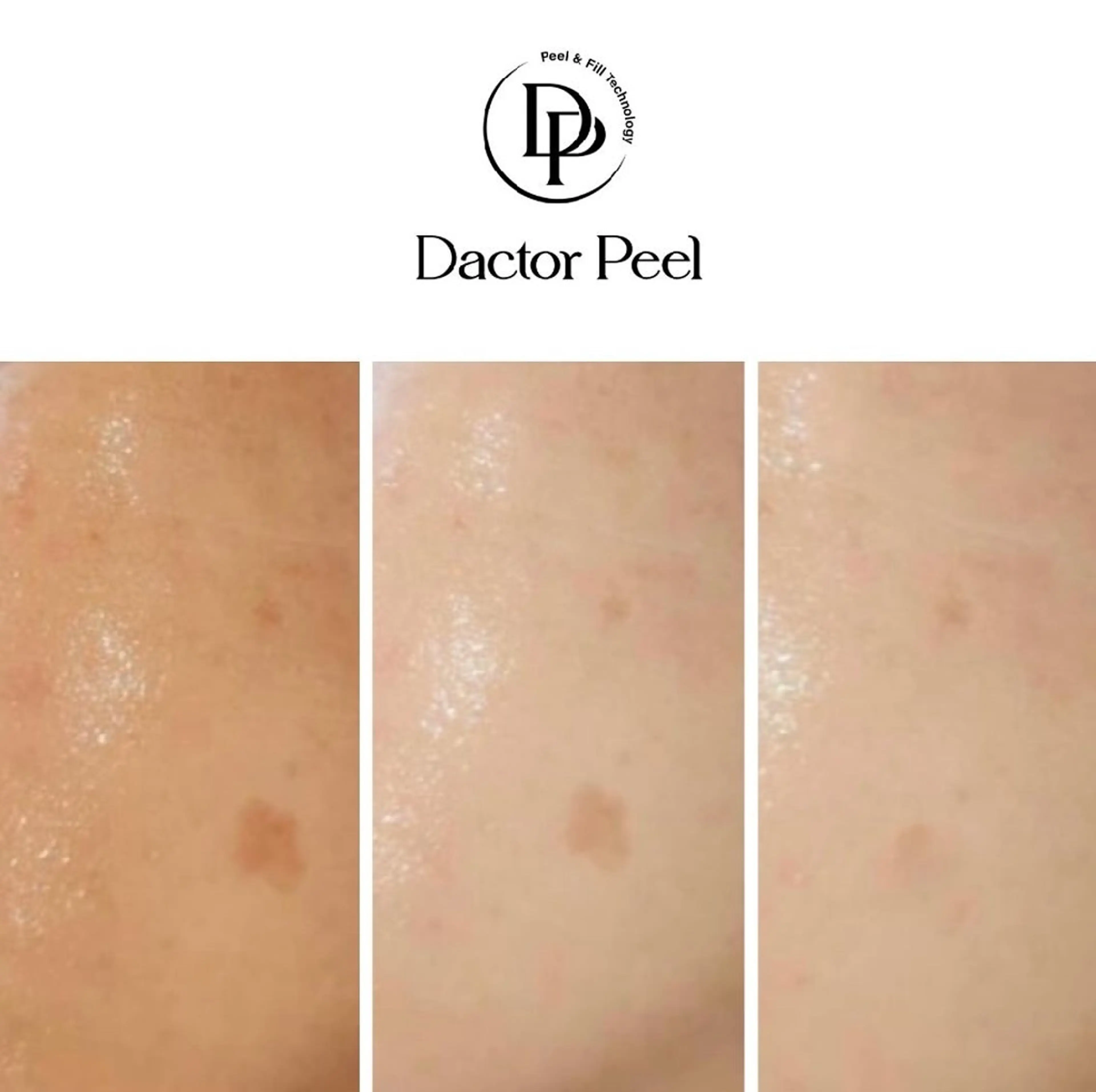 《ダクトピール》60分の写真