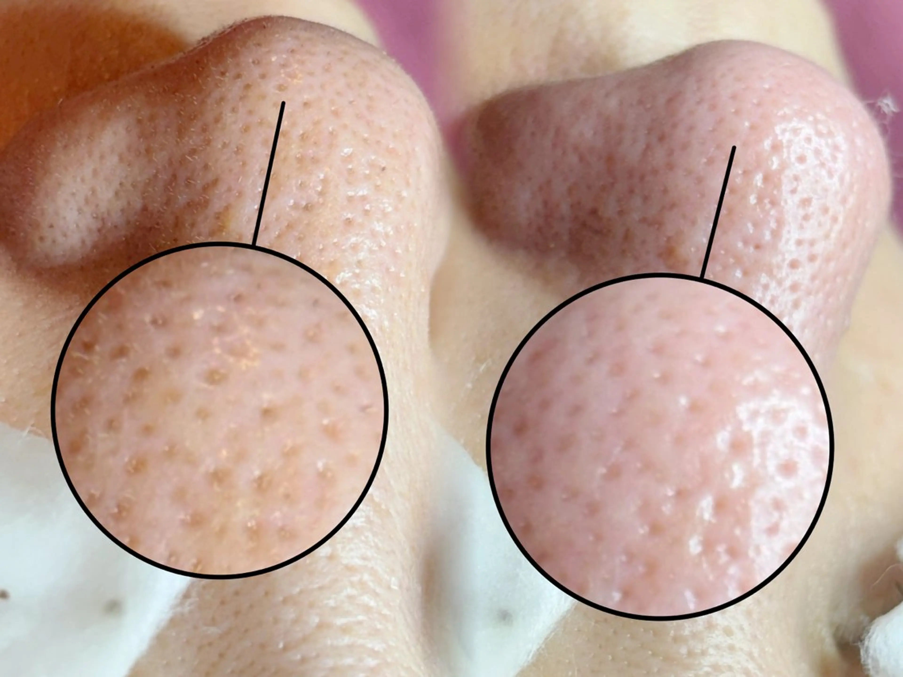 《ピーリング付き》毛穴エクストラクション（鼻のみ）➕1,000円で１パーツ追加🆗の写真