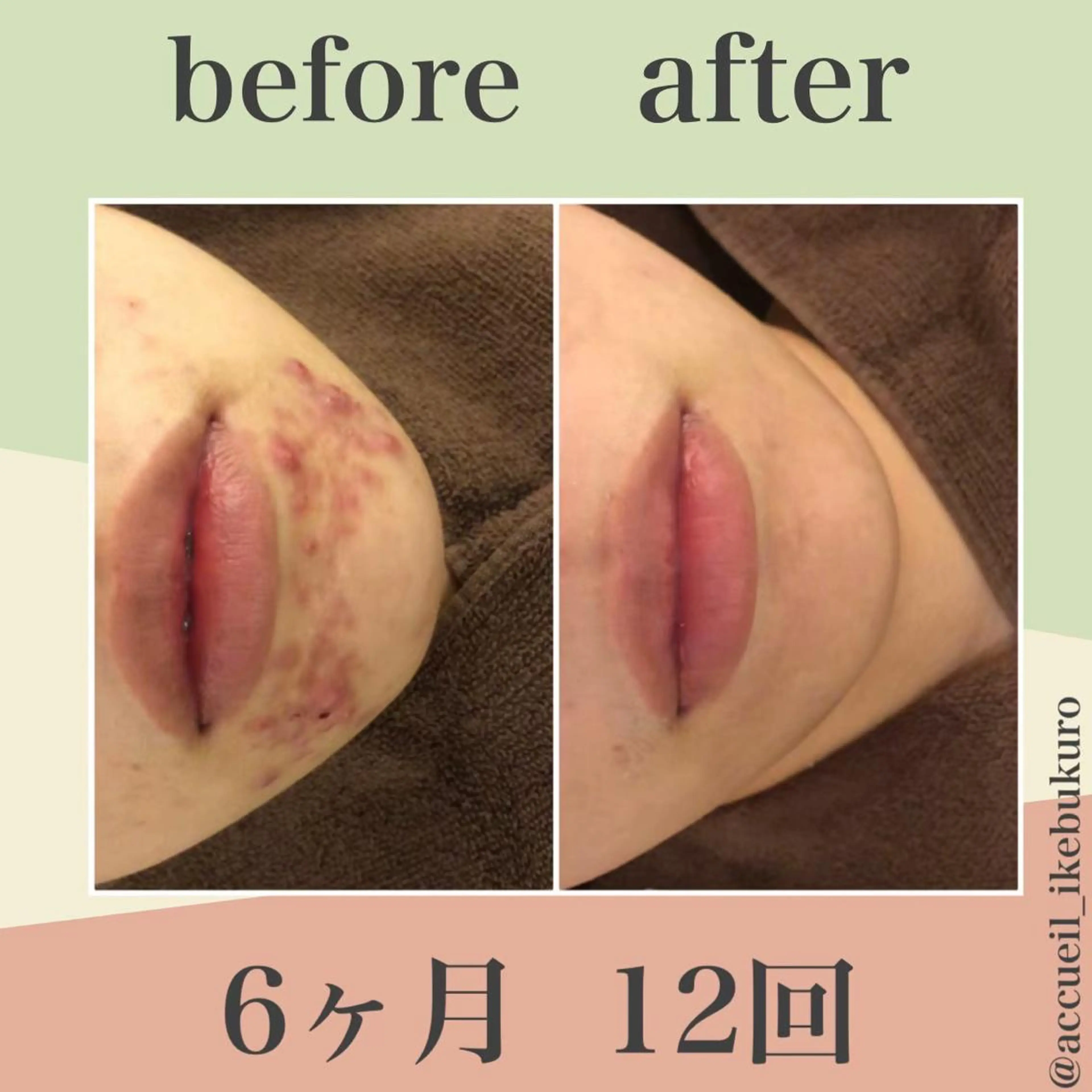 ミディアム カラー パーマ ヘアアレンジ メンズ キッズ ネイル マツエク・マツパ エステ リラク ニキビ・肌質改善専門 ♡人生が変わるサロンのエステ・リラクイメージ