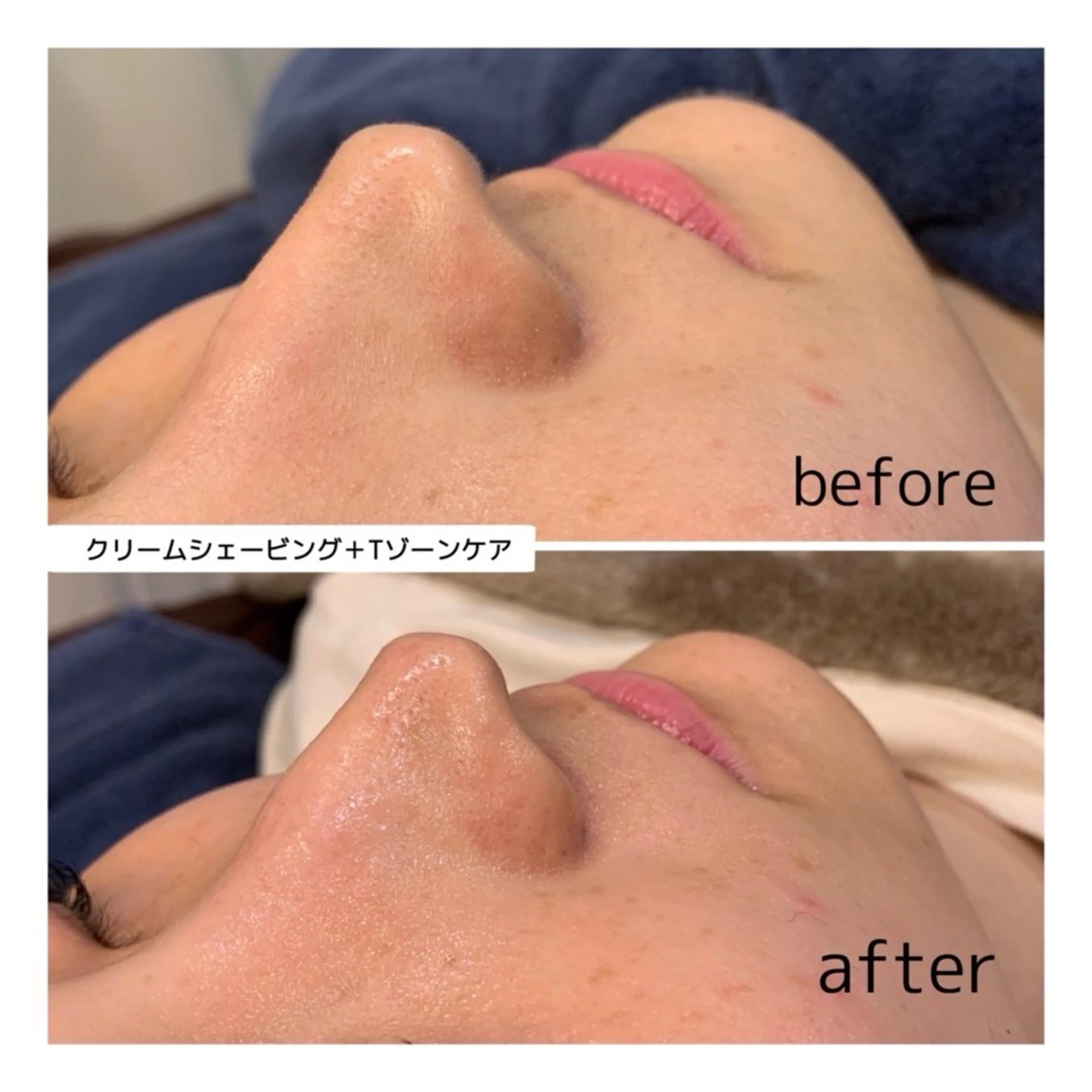 【お顔の毛穴悩みに】鼻のザラつき、保湿しても乾燥するお肌に！ ディープクレンジング×鼻パックの写真