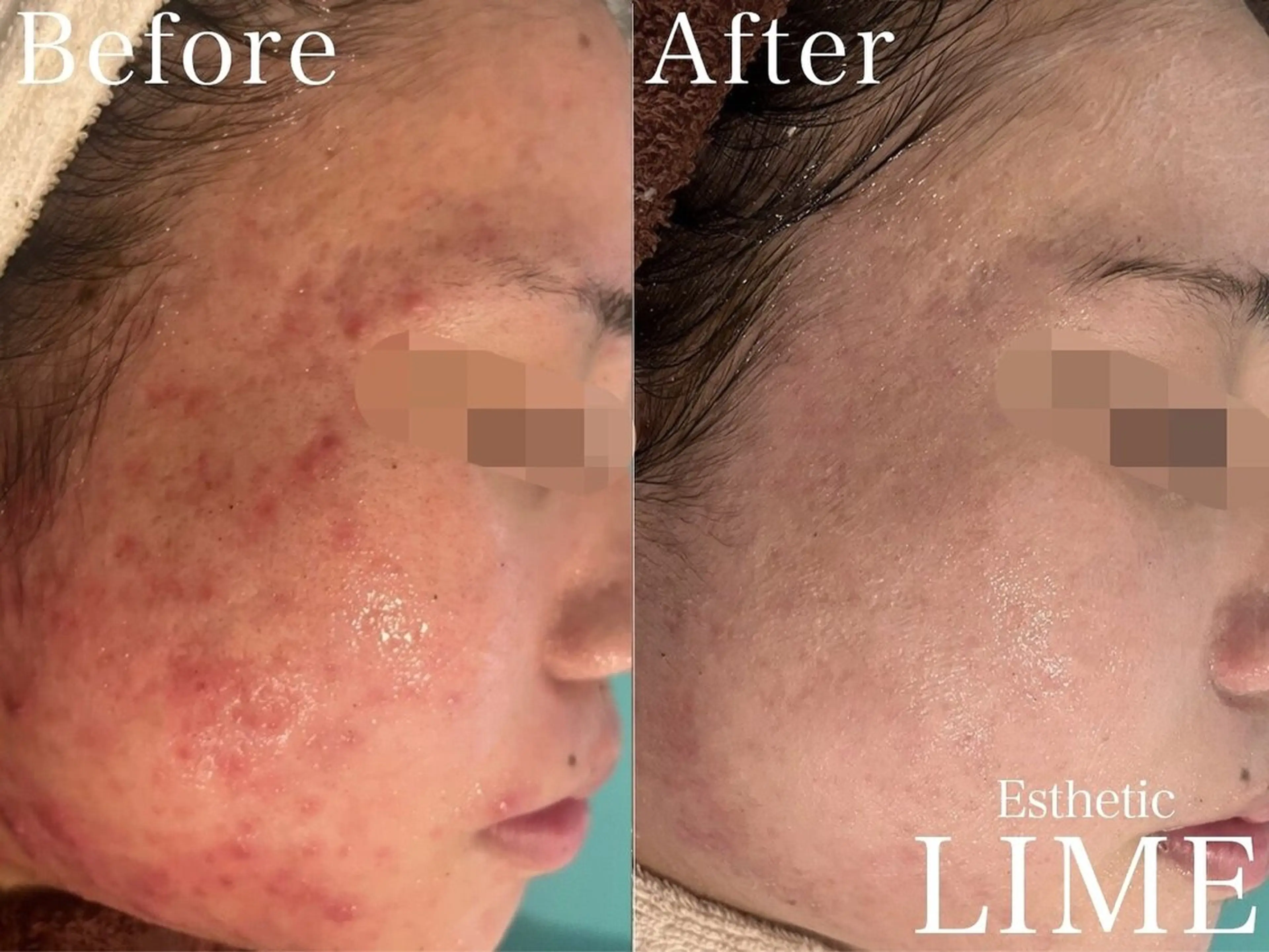 ハーブピーリング LIME池袋東口のエステ・リラクイメージ