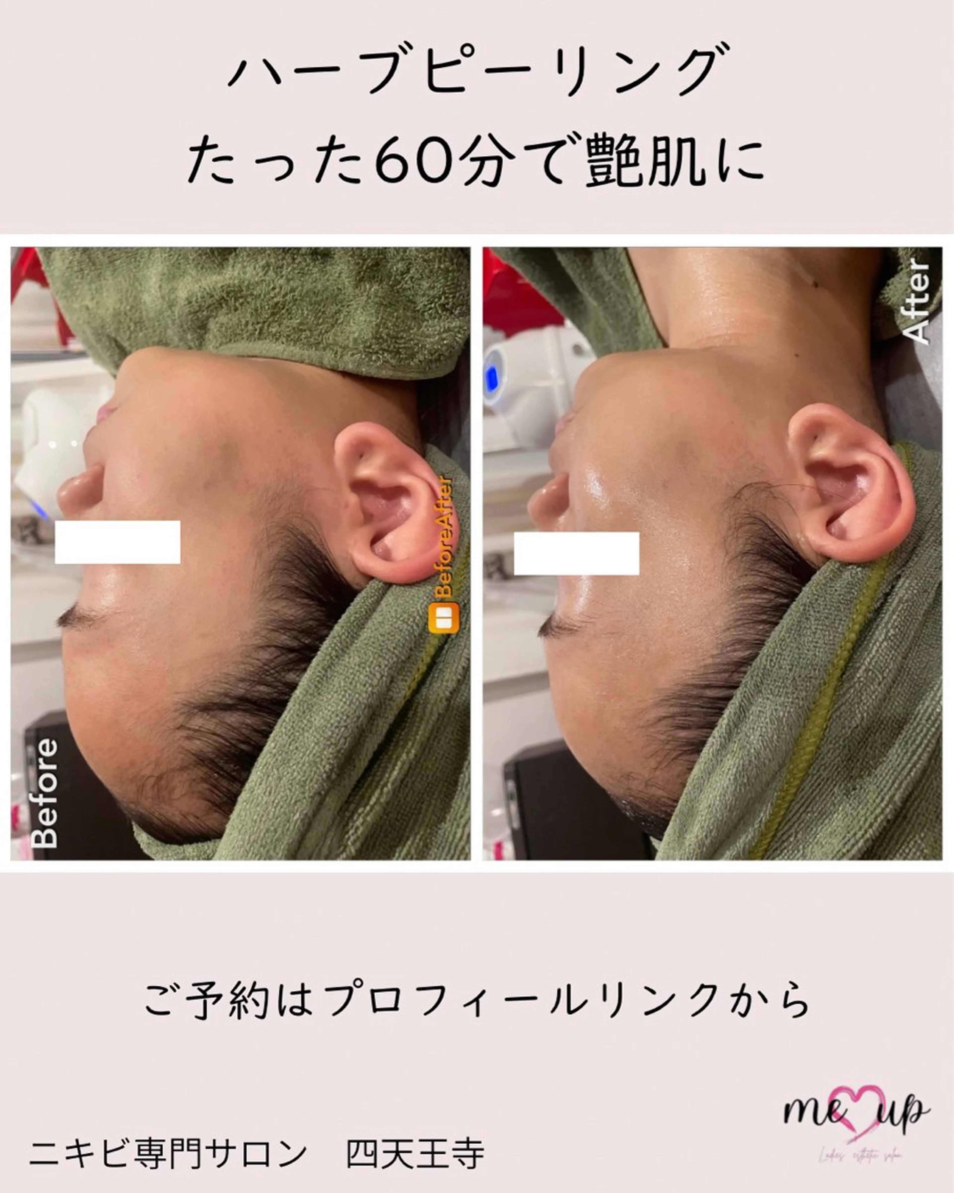 脱毛 Meupニキビ専門店 背中/ハーブ/肌管理のその他イメージ