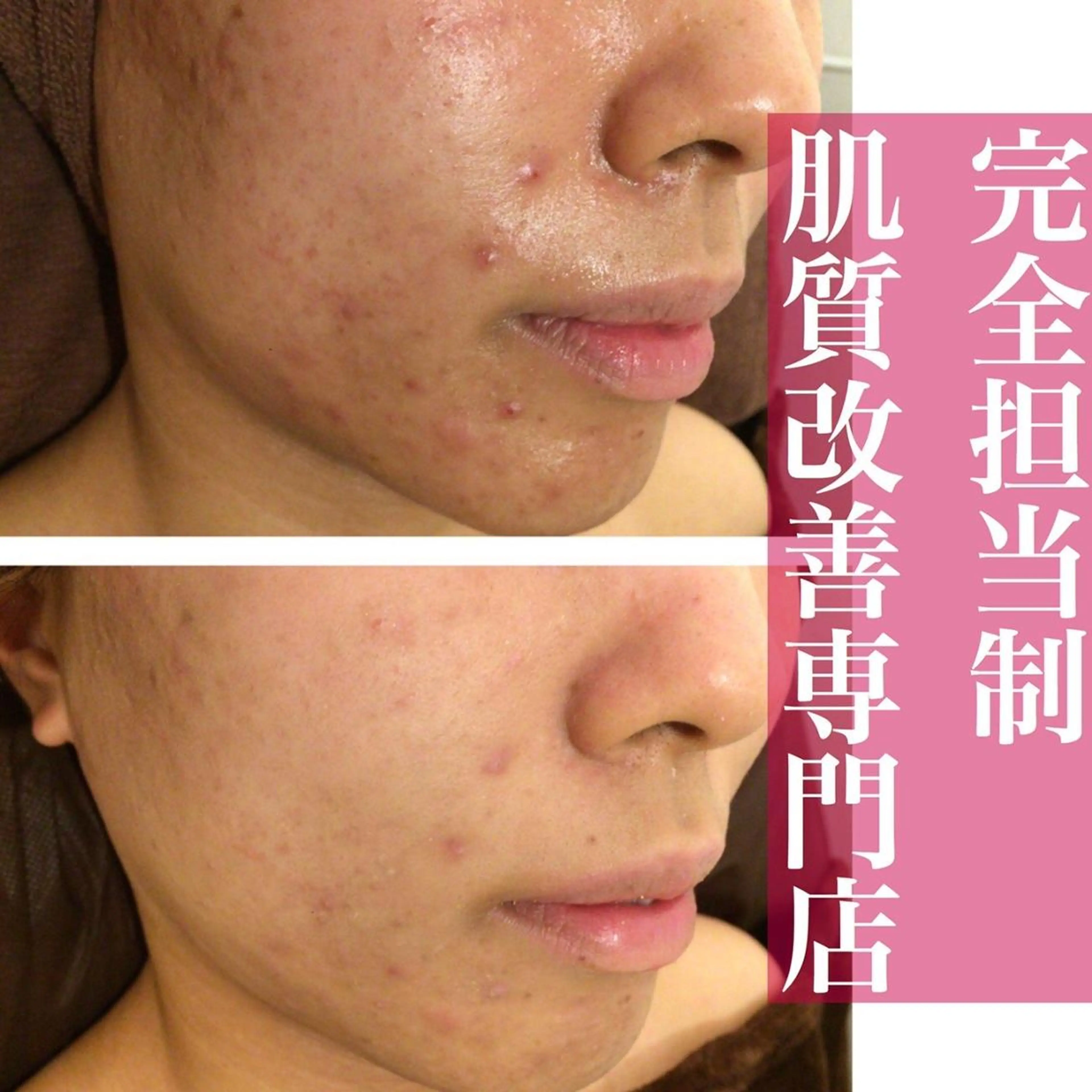 6万人の美肌実績🔥 最短ニキビ改善のエステ・リラクイメージ