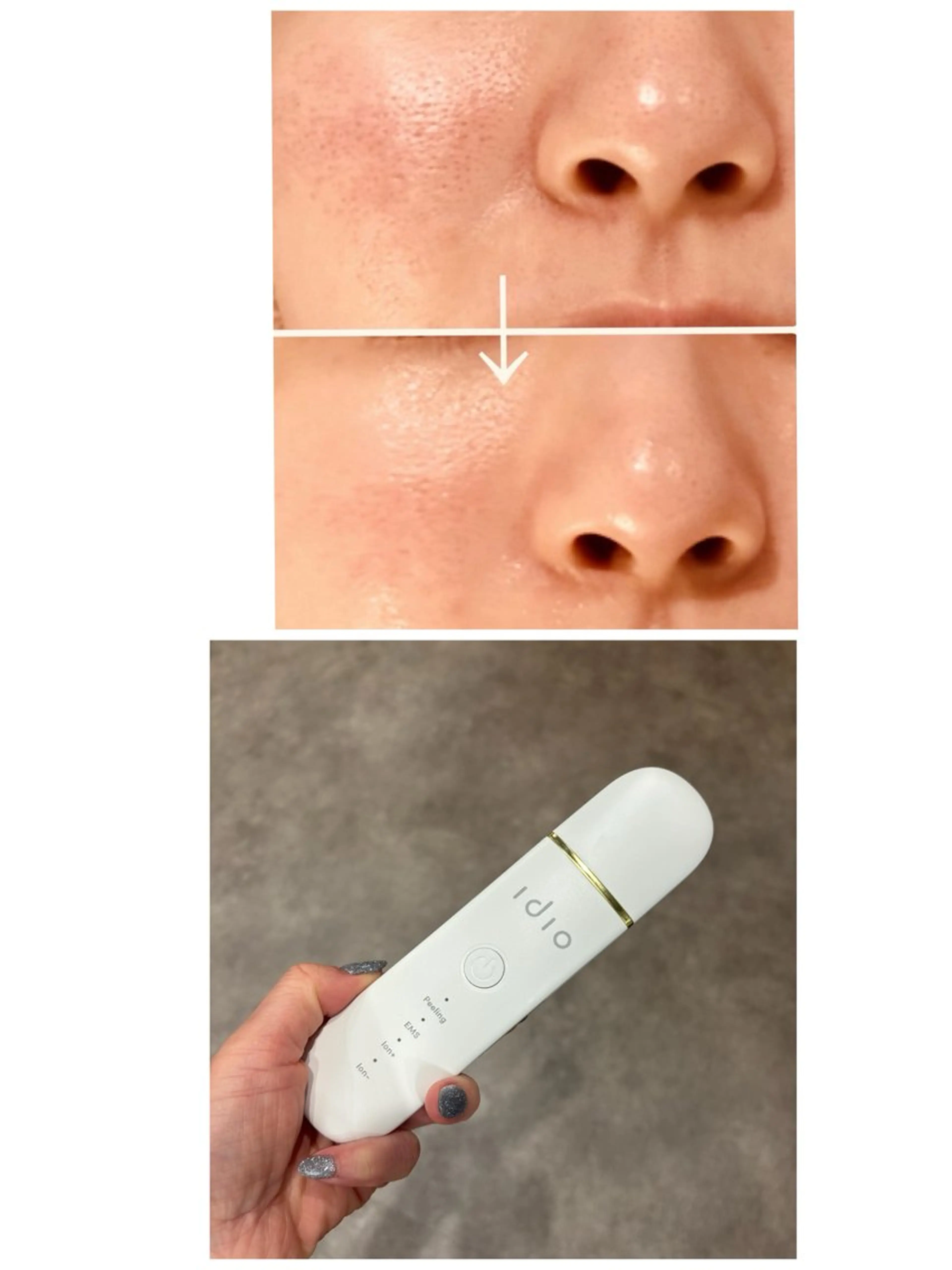 10名限定‼️お顔のウォーターピーリングでお顔の皮脂汚れを落とし、トーンアップ、ツルツル肌へ‼️保湿パック付きの写真