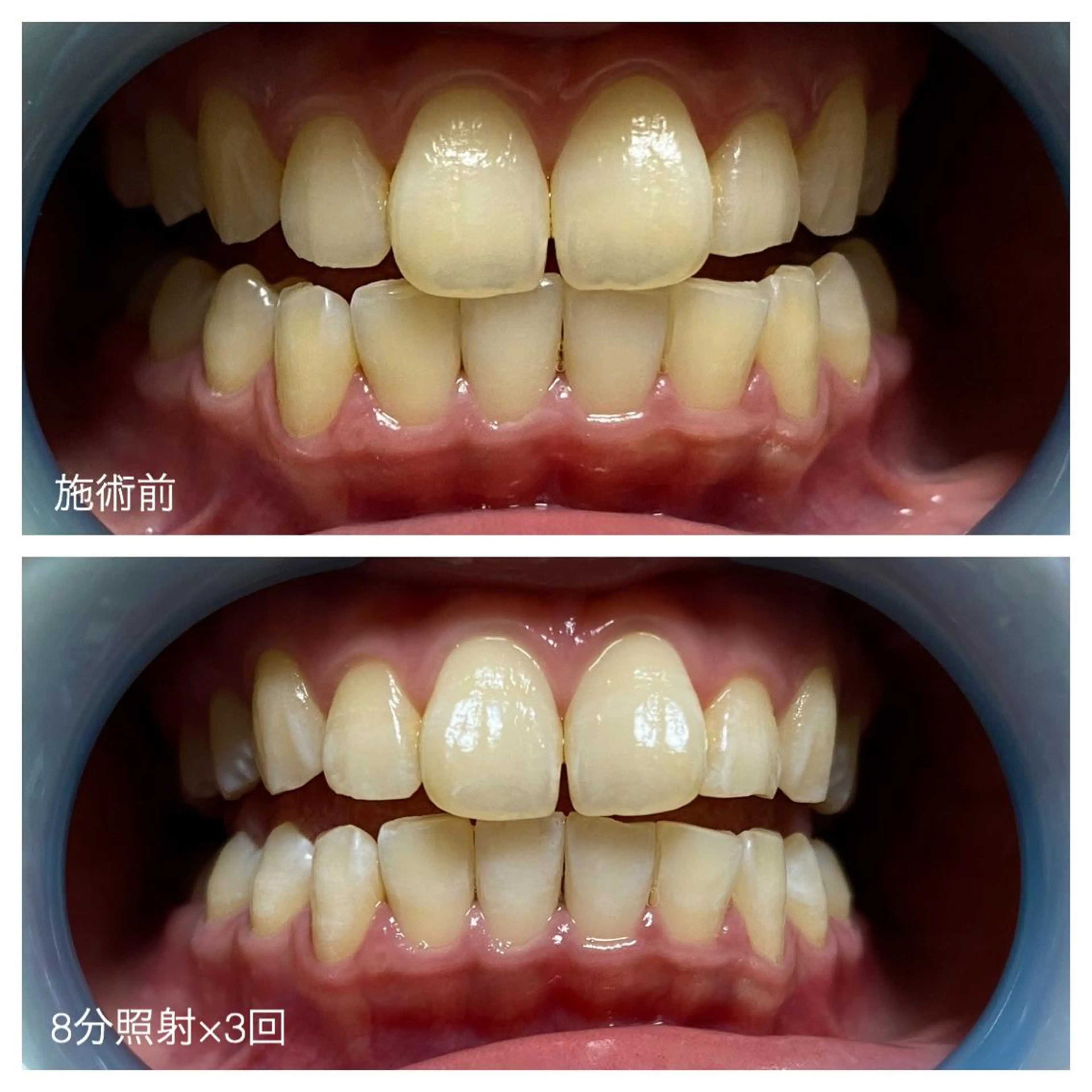 ネイル/耳つぼ /新ホワイトニングのネイルデザイン