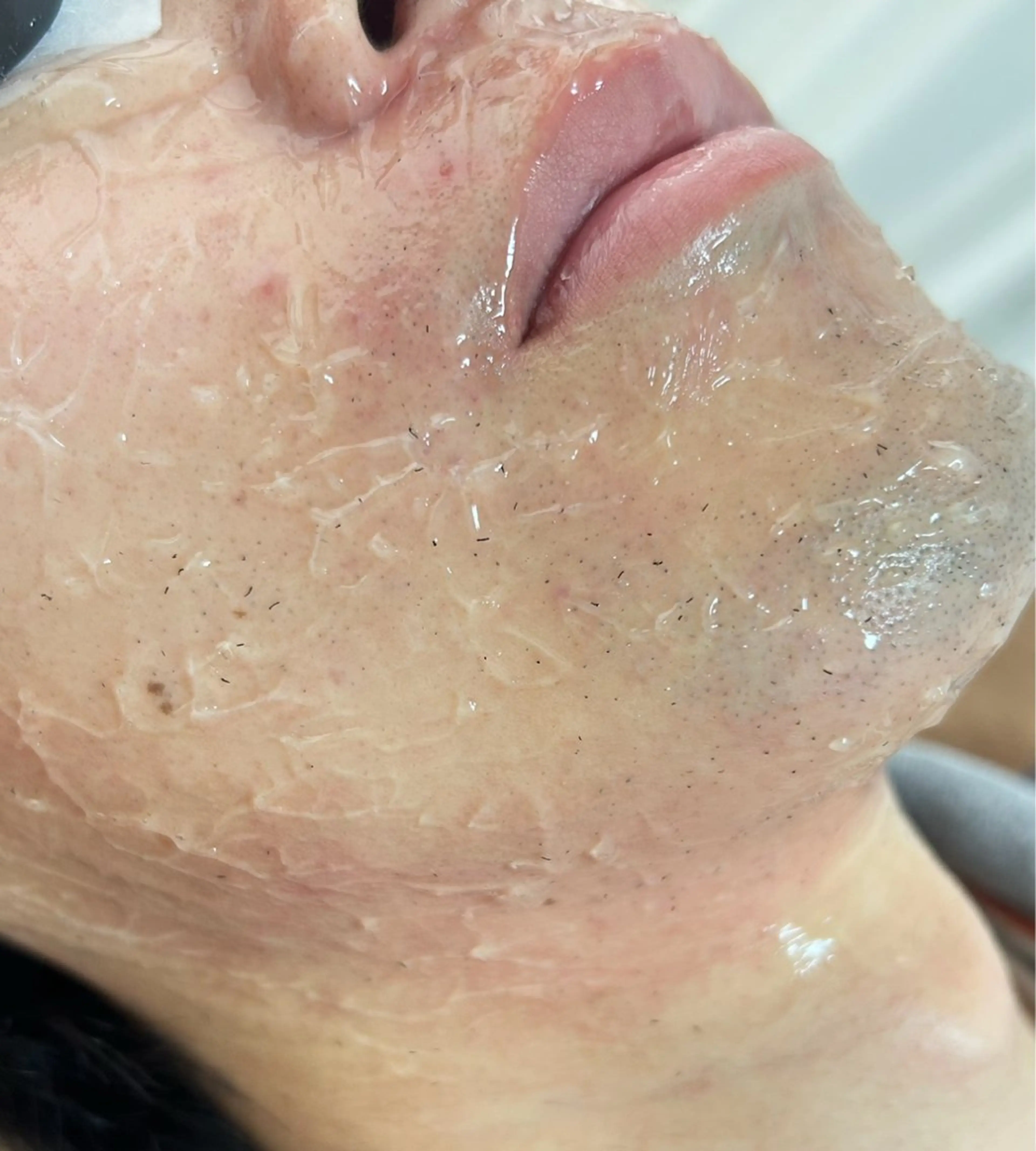 【メンズ人気No.②❗️】ヒゲ脱毛の写真