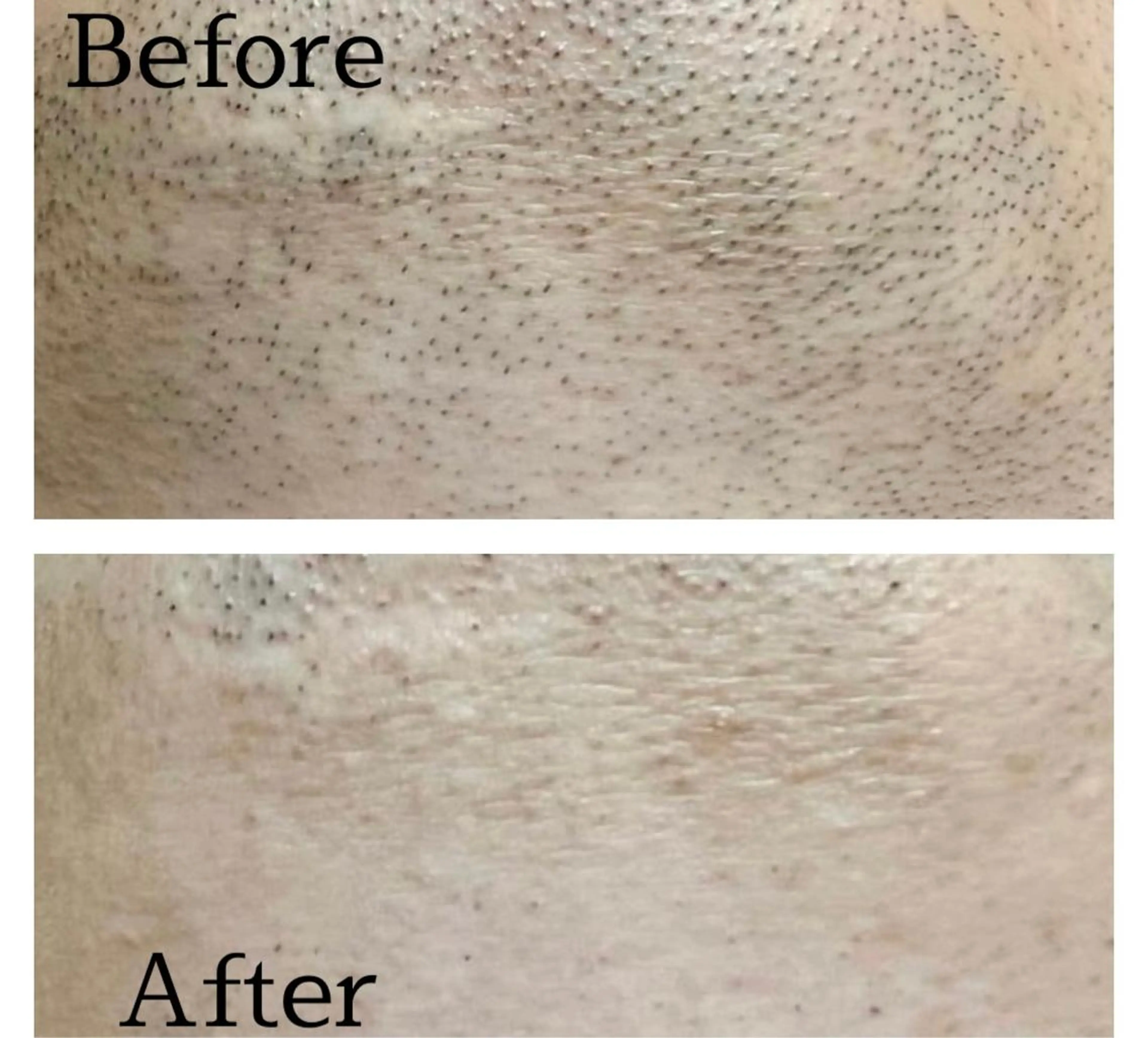 メンズ 学生（メンズ向け） 医療提携メンズ脱毛 CDFAkasakaのエステ・リラクイメージ