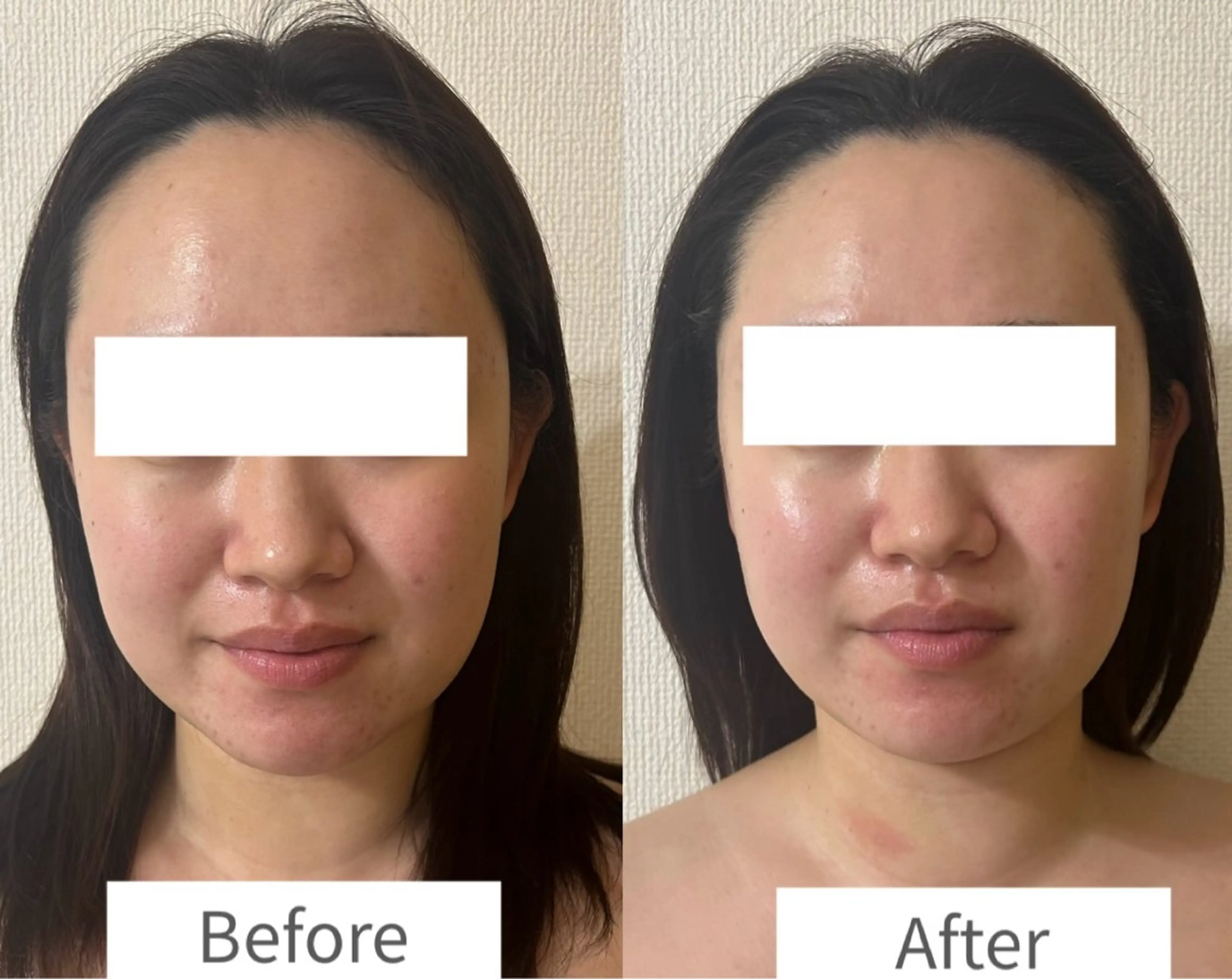 初回体験価格！モニタープラン②                              トライアングルフェイシャル®️の写真