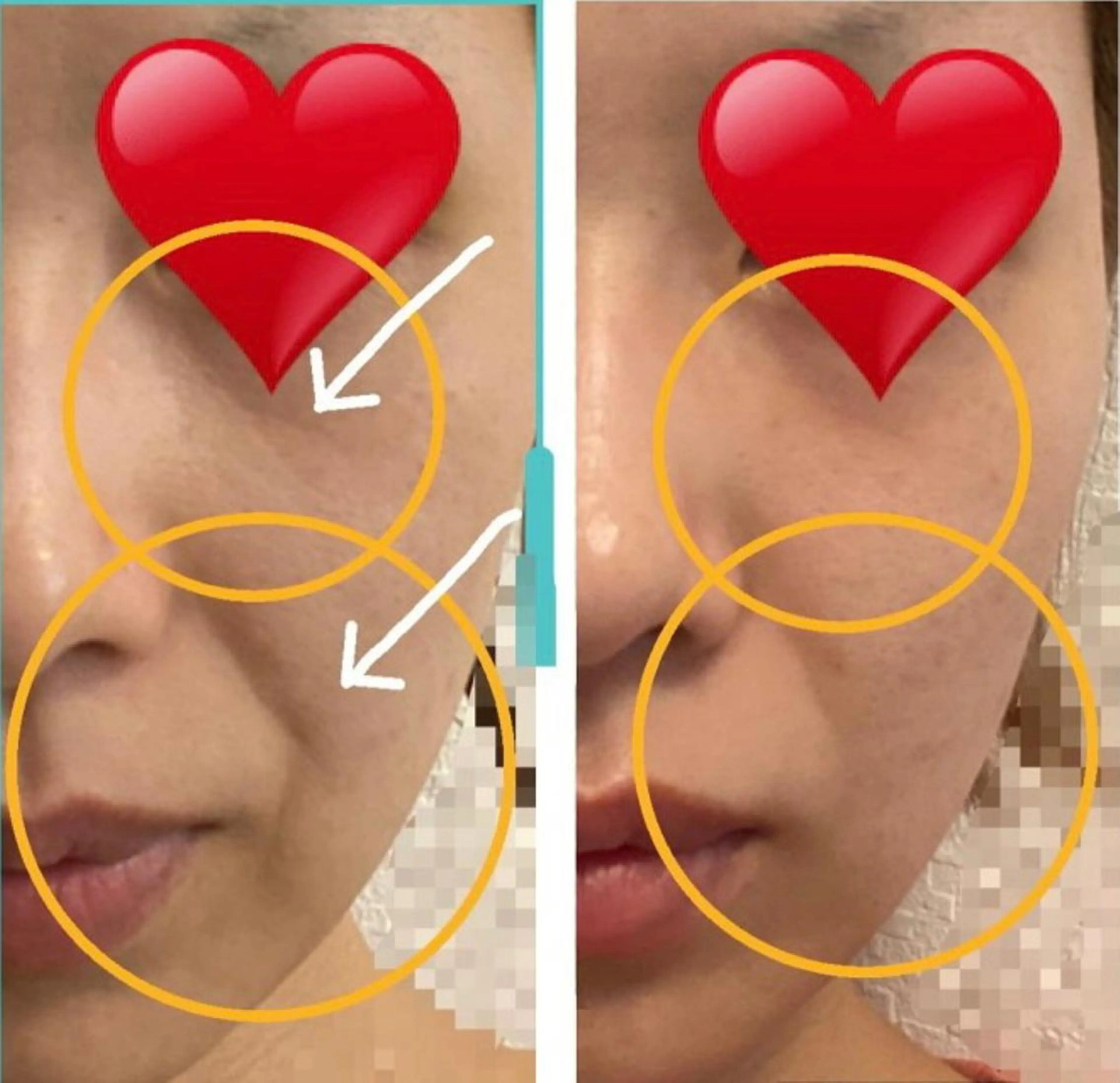 「速攻リフトUP！高周波フェイシャル✨」たるみ・むくみが気になる✔ フェイスラインを引き締めたい✔の写真