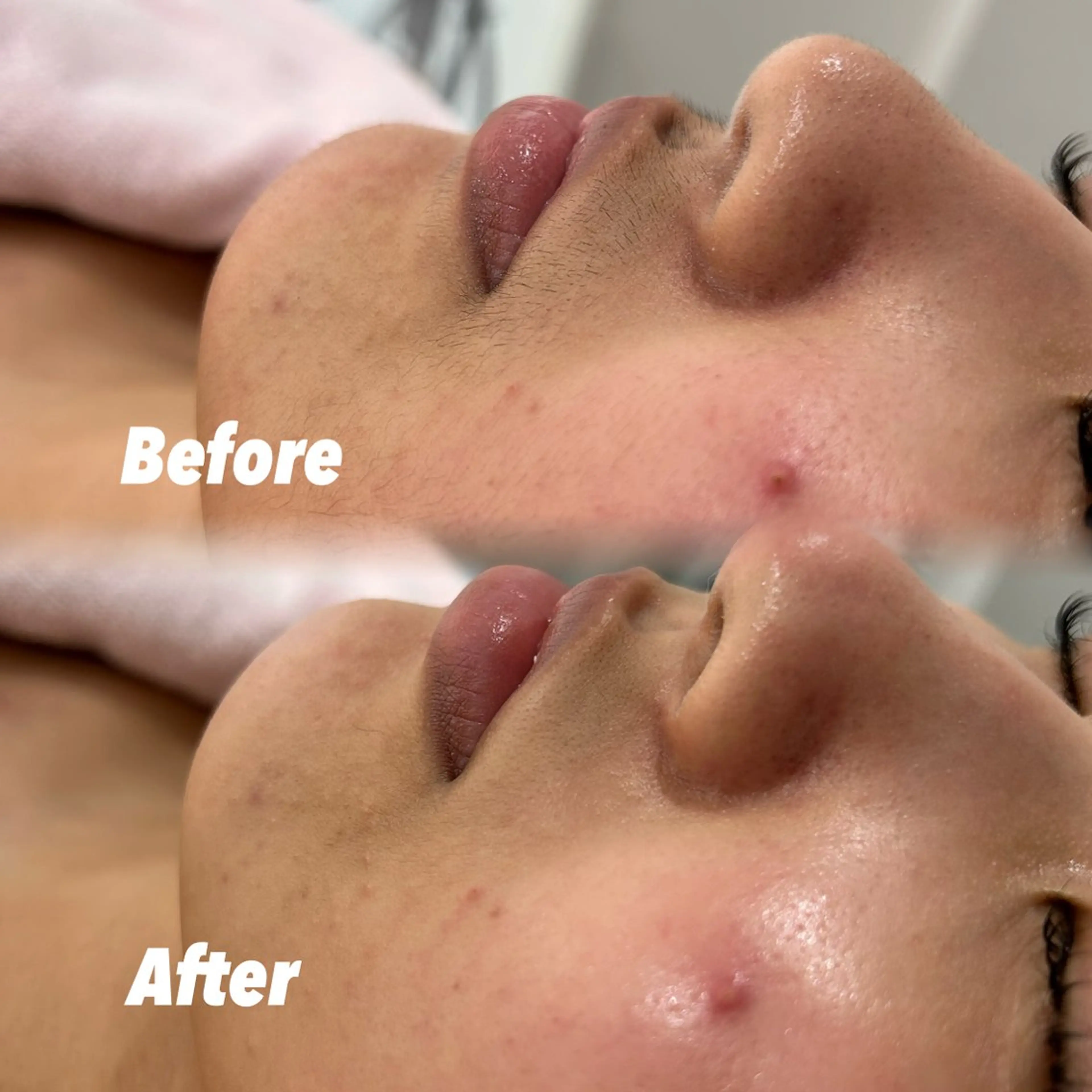 【動画撮影OKな方🎞⟡.·】⚠️12月27日土曜日19:00​〜​限定⚠️ 顔シェービング+パックの写真