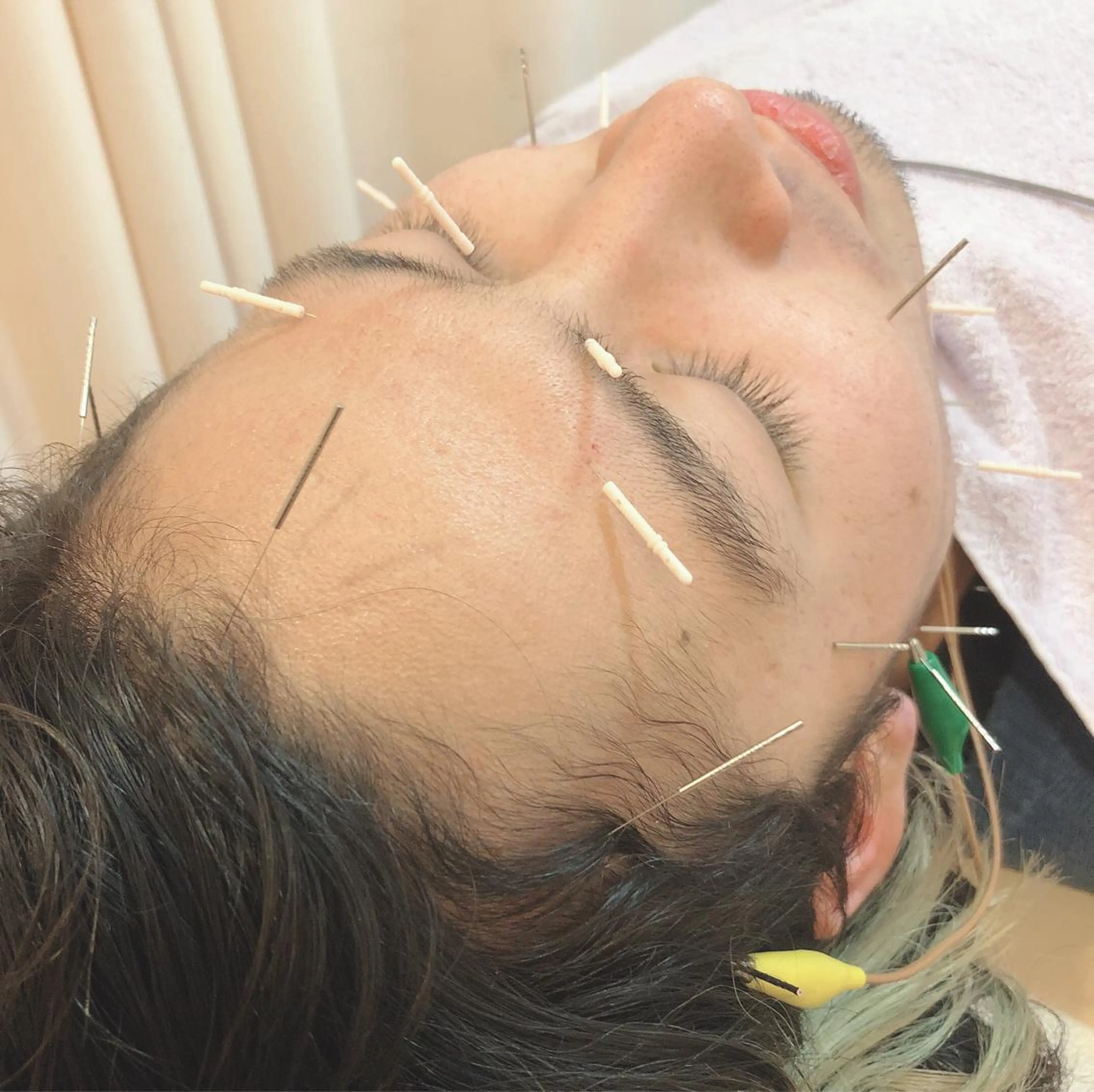 メンズ リフトアップ・たるみ ☆美容鍼小顔矯正のその他イメージ