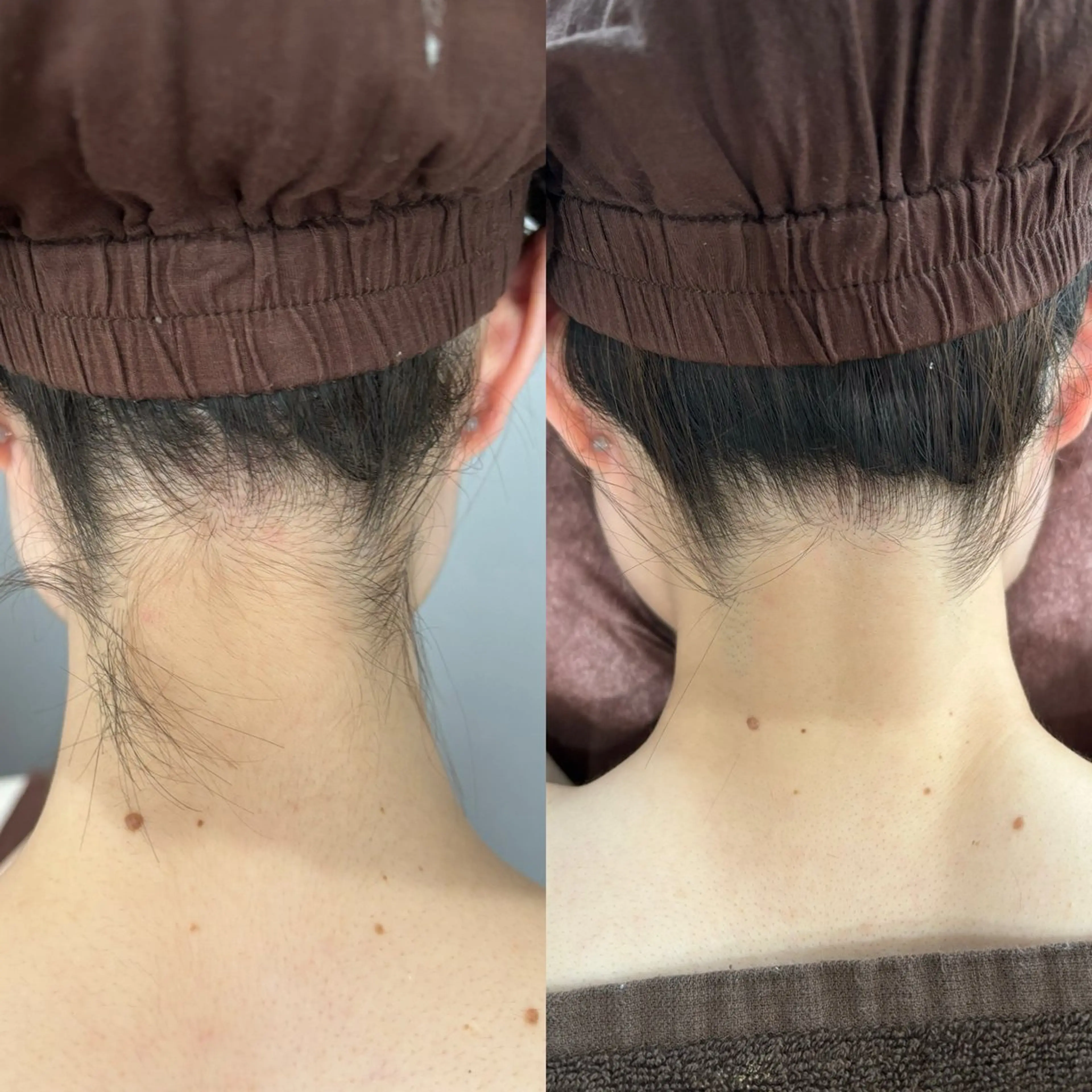 【脱毛】襟足背中セット1回【レディース限定】の写真